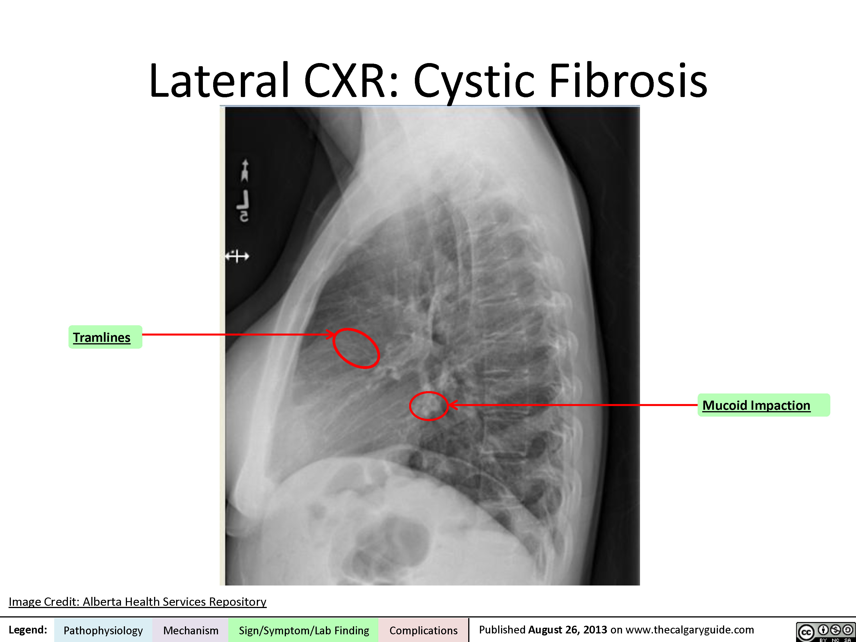  Lateral Chest X-Ray