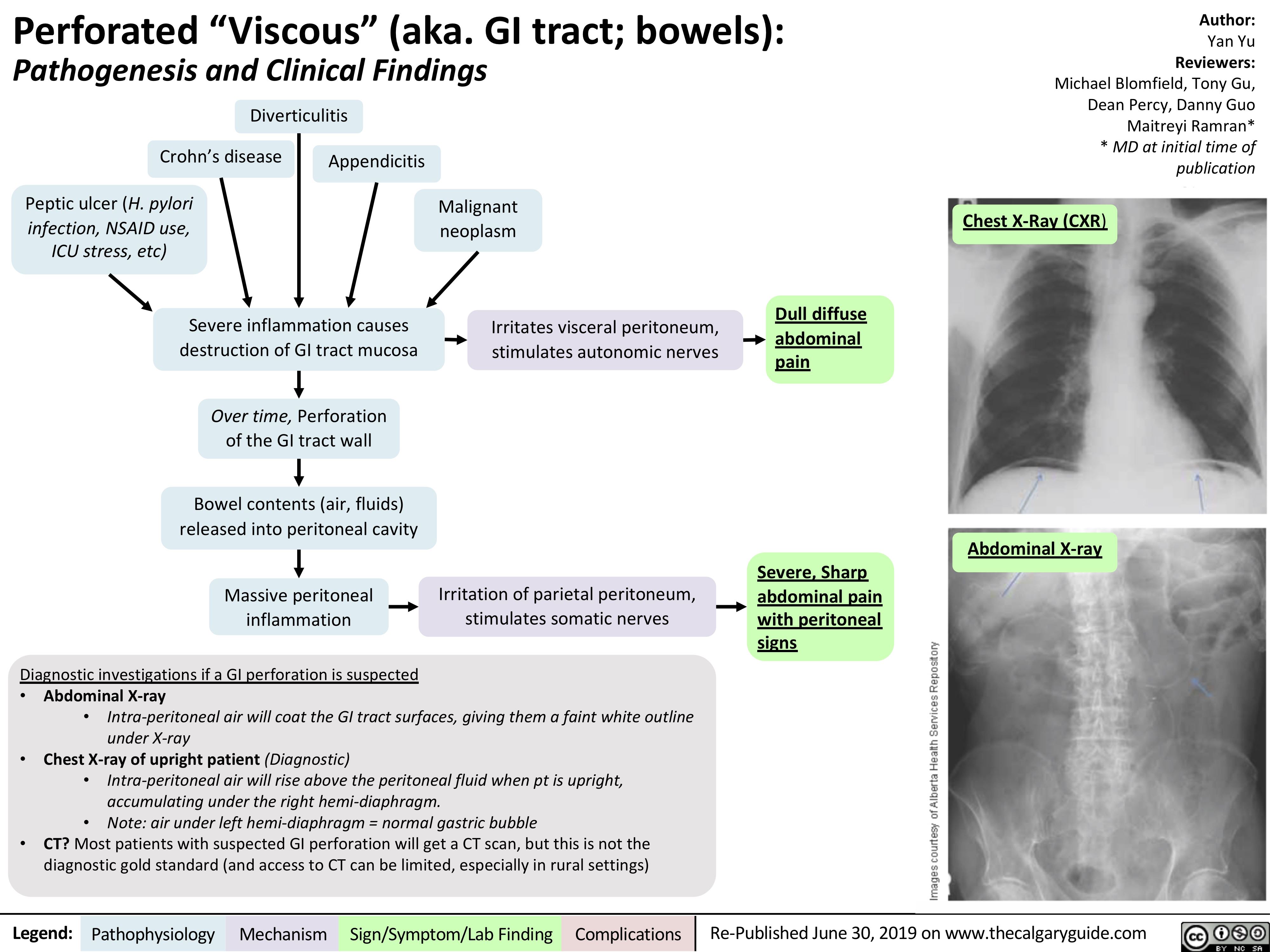 Perforated “Viscous” (aka. GI tract; bowels):
Author:
Yan Yu
Reviewers:
Michael Blomfield, Tony Gu, Dean Percy, Danny Guo Maitreyi Ramran* * MD at initial time of publication
Chest X-Ray (CXR)
Pathogenesis and Clinical Findings
Diverticulitis
   Crohn’s disease Peptic ulcer (H. pylori
infection, NSAID use, ICU stress, etc)
Appendicitis
Malignant neoplasm
Irritates visceral peritoneum, stimulates autonomic nerves
            Severe inflammation causes destruction of GI tract mucosa
Over time, Perforation of the GI tract wall
Bowel contents (air, fluids) released into peritoneal cavity
Massive peritoneal inflammation
Diagnostic investigations if a GI perforation is suspected
Dull diffuse abdominal pain
          Severe, Sharp abdominal pain with peritoneal signs
Abdominal X-ray
  Irritation of parietal peritoneum, stimulates somatic nerves
      • Abdominal X-ray
• Intra-peritoneal air will coat the GI tract surfaces, giving them a faint white outline
under X-ray
• Chest X-ray of upright patient (Diagnostic)
• Intra-peritoneal air will rise above the peritoneal fluid when pt is upright, accumulating under the right hemi-diaphragm.
• Note: air under left hemi-diaphragm = normal gastric bubble
• CT? Most patients with suspected GI perforation will get a CT scan, but this is not the diagnostic gold standard (and access to CT can be limited, especially in rural settings)
 Legend:
 Pathophysiology
 Mechanism
Sign/Symptom/Lab Finding
  Complications
Re-Published June 30, 2019 on www.thecalgaryguide.com
   