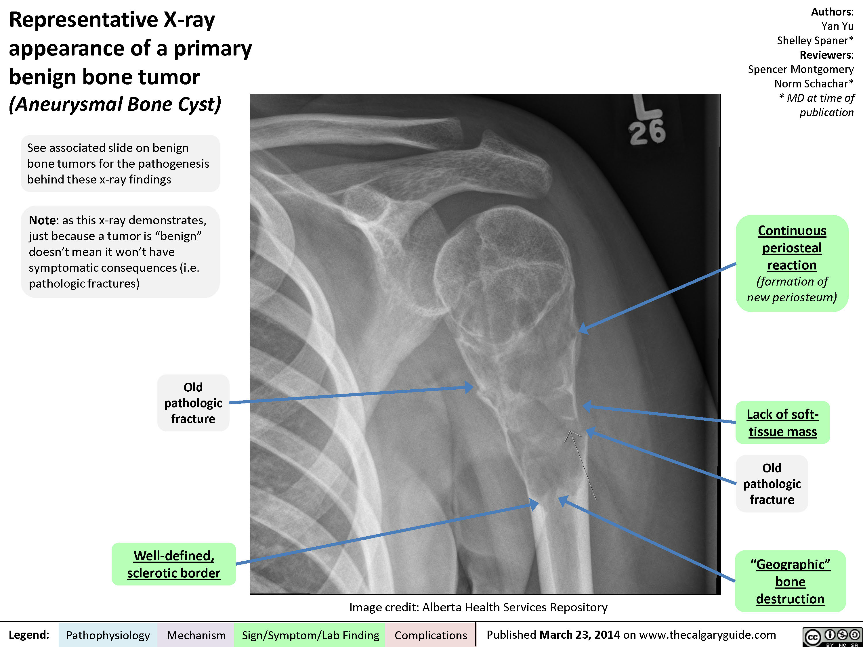 Representative X-ray appearance of a primary benign bone tumor