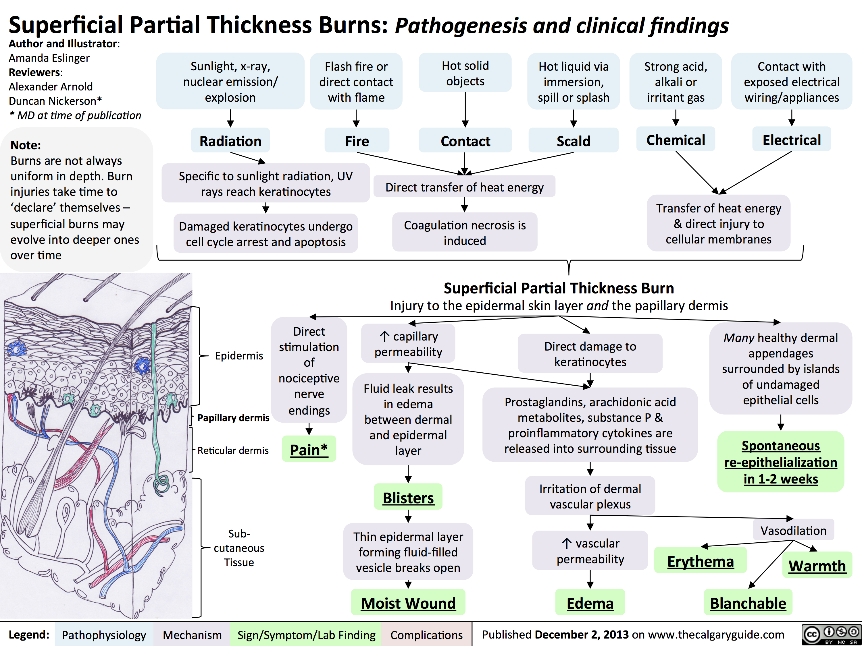 Superficial Partial Thickness Burns - Pathogenesis and Clinical Findings