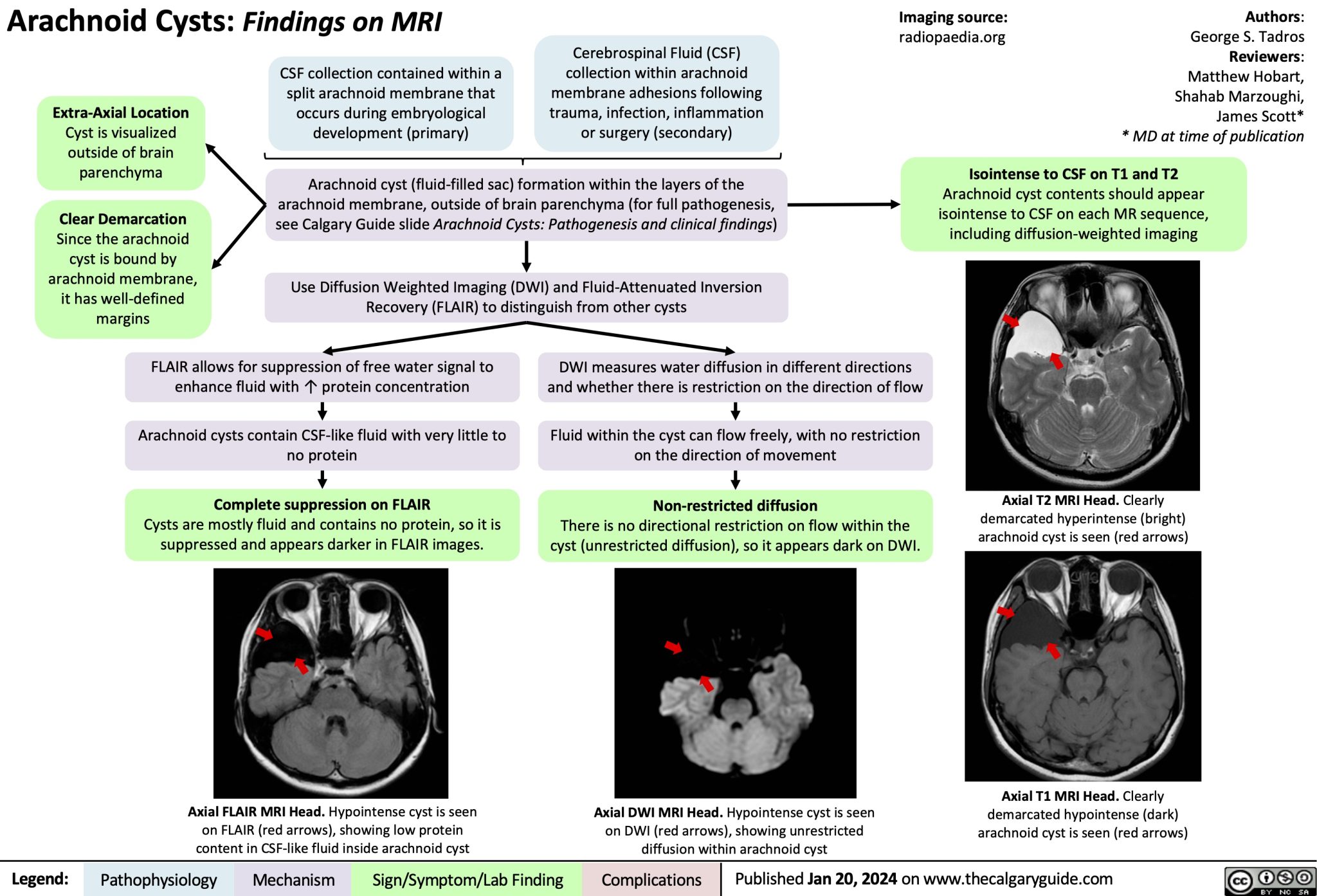 Arachnoid Cysts MRI Findings Calgary Guide