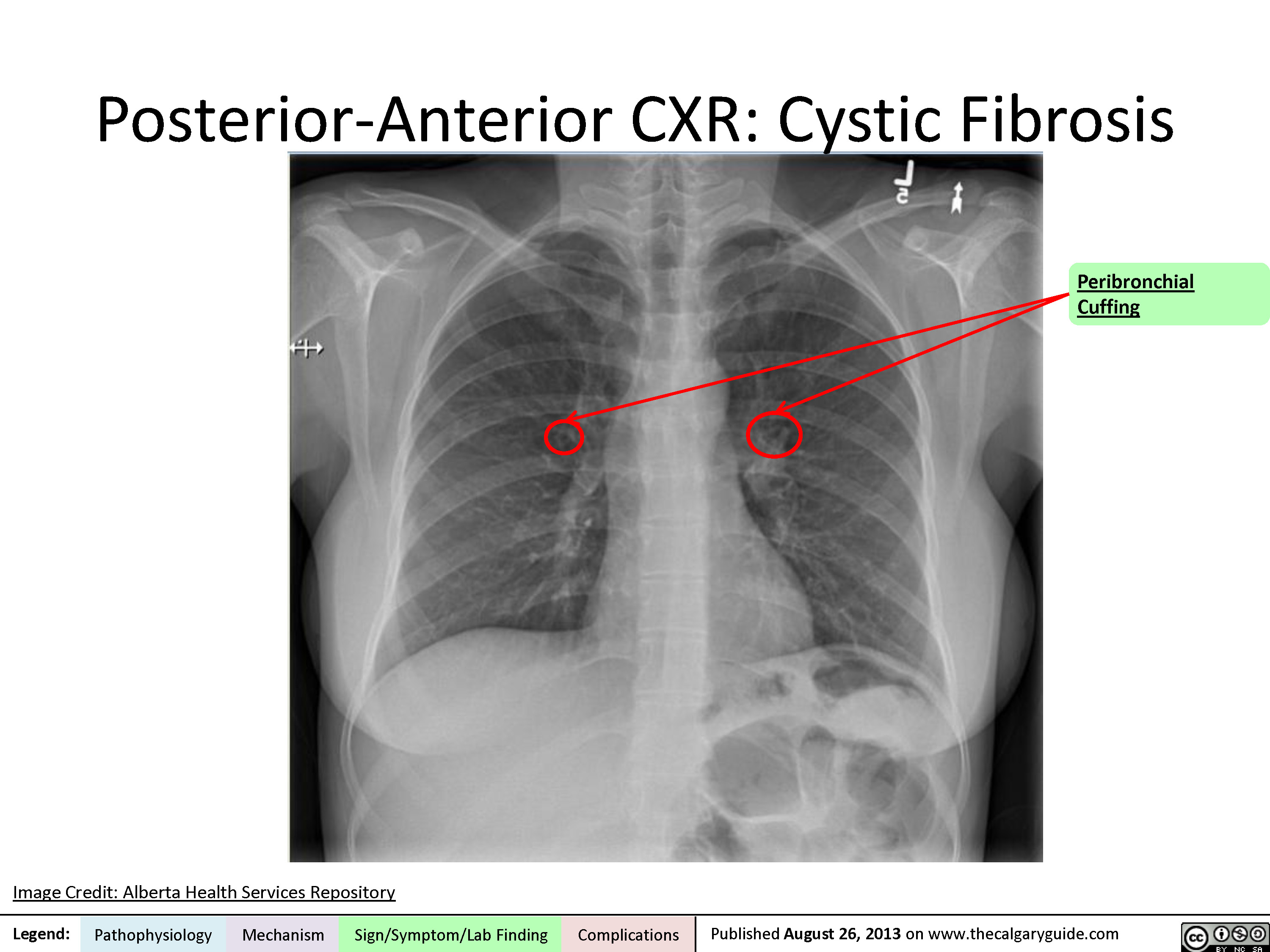 Cystic Fibrosis: Posterior-Anterior Chest X-Ray | Calgary Guide