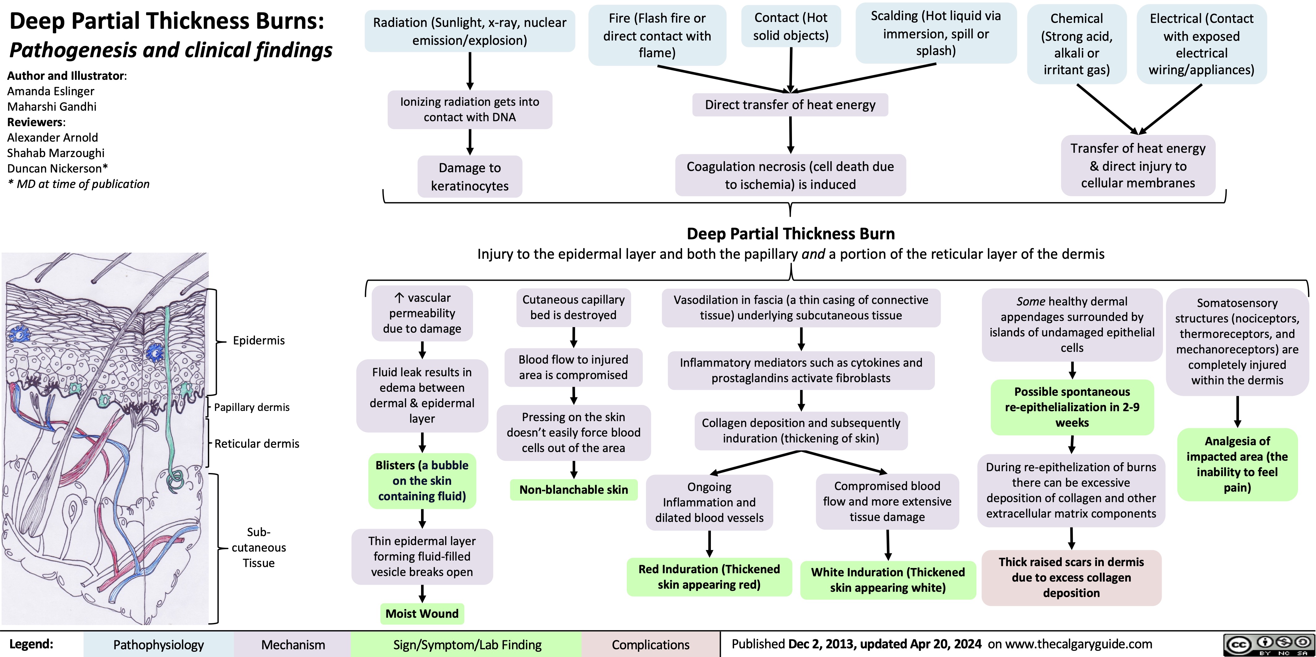    Deep Partial Thickness Burns:
Pathogenesis and clinical findings
Radiation (Sunlight, x-ray, nuclear emission/explosion)
Ionizing radiation gets into contact with DNA
Damage to keratinocytes
Fire (Flash fire or direct contact with flame)
Contact (Hot solid objects)
Scalding (Hot liquid via immersion, spill or splash)
Chemical (Strong acid, alkali or irritant gas)
Electrical (Contact with exposed electrical wiring/appliances)
     Author and Illustrator: Amanda Eslinger Maharshi Gandhi Reviewers:
Alexander Arnold
Shahab Marzoughi
Duncan Nickerson*
* MD at time of publication
Direct transfer of heat energy
Coagulation necrosis (cell death due to ischemia) is induced
Deep Partial Thickness Burn
Injury to the epidermal layer and both the papillary and a portion of the reticular layer of the dermis
     Transfer of heat energy & direct injury to cellular membranes
           Epidermis
Papillary dermis Reticular dermis
Sub- cutaneous Tissue
↑ vascular permeability due to damage
Fluid leak results in edema between dermal & epidermal layer
Blisters (a bubble on the skin containing fluid)
Thin epidermal layer forming fluid-filled vesicle breaks open
Cutaneous capillary bed is destroyed
Blood flow to injured area is compromised
Pressing on the skin doesn’t easily force blood cells out of the area
Non-blanchable skin
Vasodilation in fascia (a thin casing of connective tissue) underlying subcutaneous tissue
Inflammatory mediators such as cytokines and prostaglandins activate fibroblasts
Collagen deposition and subsequently induration (thickening of skin)
Some healthy dermal appendages surrounded by islands of undamaged epithelial cells
Possible spontaneous re-epithelialization in 2-9 weeks
During re-epithelization of burns there can be excessive deposition of collagen and other extracellular matrix components
Thick raised scars in dermis due to excess collagen deposition
Somatosensory structures (nociceptors, thermoreceptors, and mechanoreceptors) are completely injured within the dermis
Analgesia of impacted area (the inability to feel pain)
               Ongoing Inflammation and dilated blood vessels
Red Induration (Thickened skin appearing red)
Compromised blood flow and more extensive tissue damage
White Induration (Thickened skin appearing white)
      Moist Wound
 Legend:
 Pathophysiology
Mechanism
Sign/Symptom/Lab Finding
 Complications
 Published Dec 2, 2013, updated Apr 20, 2024 on www.thecalgaryguide.com
   