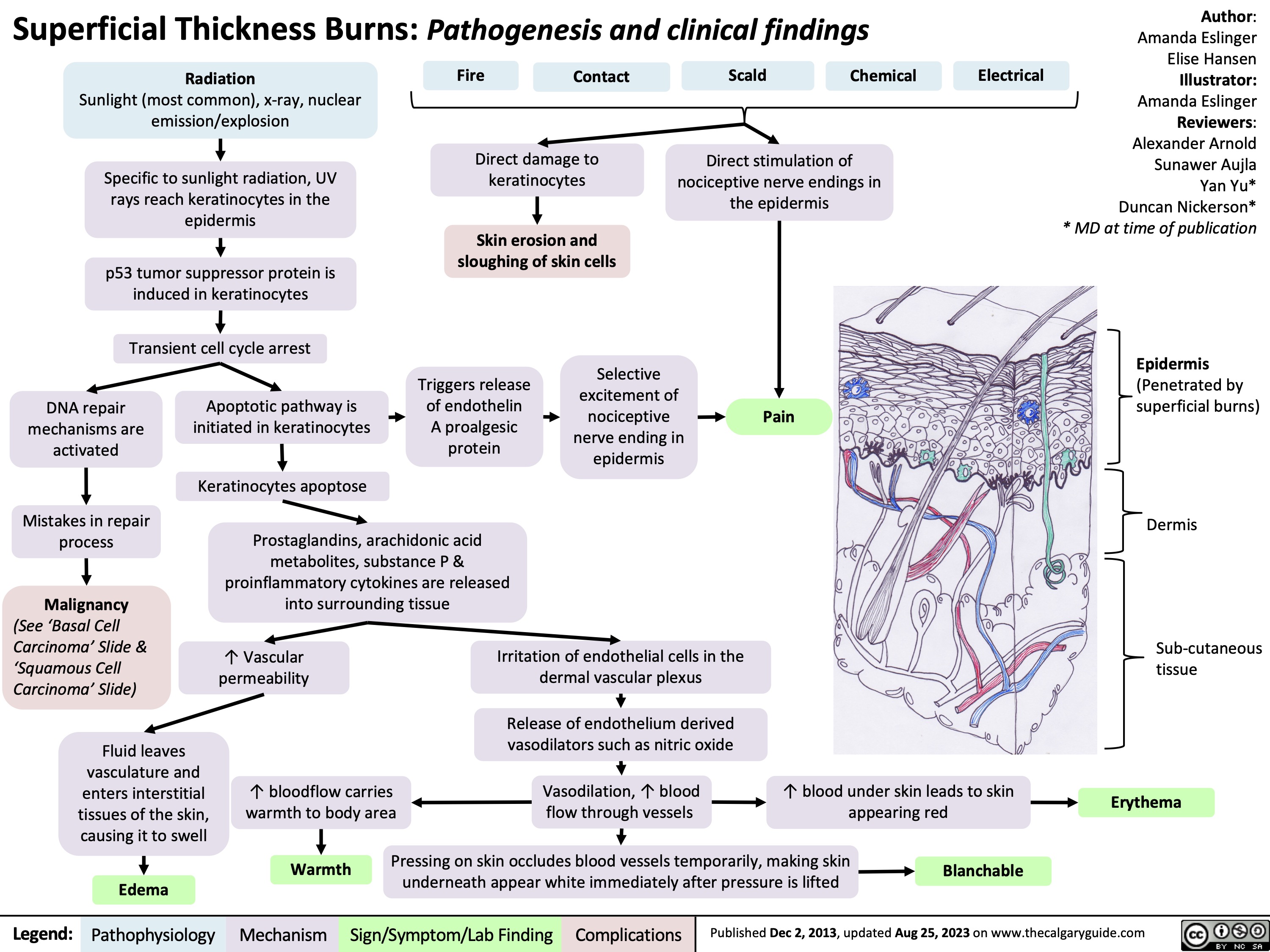 Superficial Thickness Burns: Pathogenesis and clinical findings
Author: Amanda Eslinger Elise Hansen Illustrator: Amanda Eslinger Reviewers: Alexander Arnold Sunawer Aujla Yan Yu* Duncan Nickerson* * MD at time of publication
Epidermis
(Penetrated by superficial burns)
Dermis
Sub-cutaneous tissue
Erythema
      Radiation
Sunlight (most common), x-ray, nuclear emission/explosion
Specific to sunlight radiation, UV rays reach keratinocytes in the epidermis
p53 tumor suppressor protein is induced in keratinocytes
Transient cell cycle arrest Apoptotic pathway is
Fire
Contact
Scald
Chemical
Electrical
    Direct damage to keratinocytes
Skin erosion and sloughing of skin cells
Direct stimulation of nociceptive nerve endings in the epidermis
            DNA repair mechanisms are activated
Mistakes in repair process
Malignancy
(See ‘Basal Cell Carcinoma’ Slide & ‘Squamous Cell Carcinoma’ Slide)
Fluid leaves vasculature and enters interstitial tissues of the skin, causing it to swell
Edema
Triggers release of endothelin A proalgesic protein
Selective excitement of nociceptive nerve ending in epidermis
Pain
 initiated in keratinocytes
Keratinocytes apoptose
     Prostaglandins, arachidonic acid metabolites, substance P & proinflammatory cytokines are released into surrounding tissue
      ↑ Vascular permeability
↑ bloodflow carries warmth to body area
Irritation of endothelial cells in the dermal vascular plexus
Release of endothelium derived vasodilators such as nitric oxide
Vasodilation, ↑ blood flow through vessels
↑ blood under skin leads to skin appearing red
         Warmth Pressing on skin occludes blood vessels temporarily, making skin Blanchable underneath appear white immediately after pressure is lifted
    Legend:
 Pathophysiology
 Mechanism
Sign/Symptom/Lab Finding
 Complications
 Published Dec 2, 2013, updated Aug 25, 2023 on www.thecalgaryguide.com
  