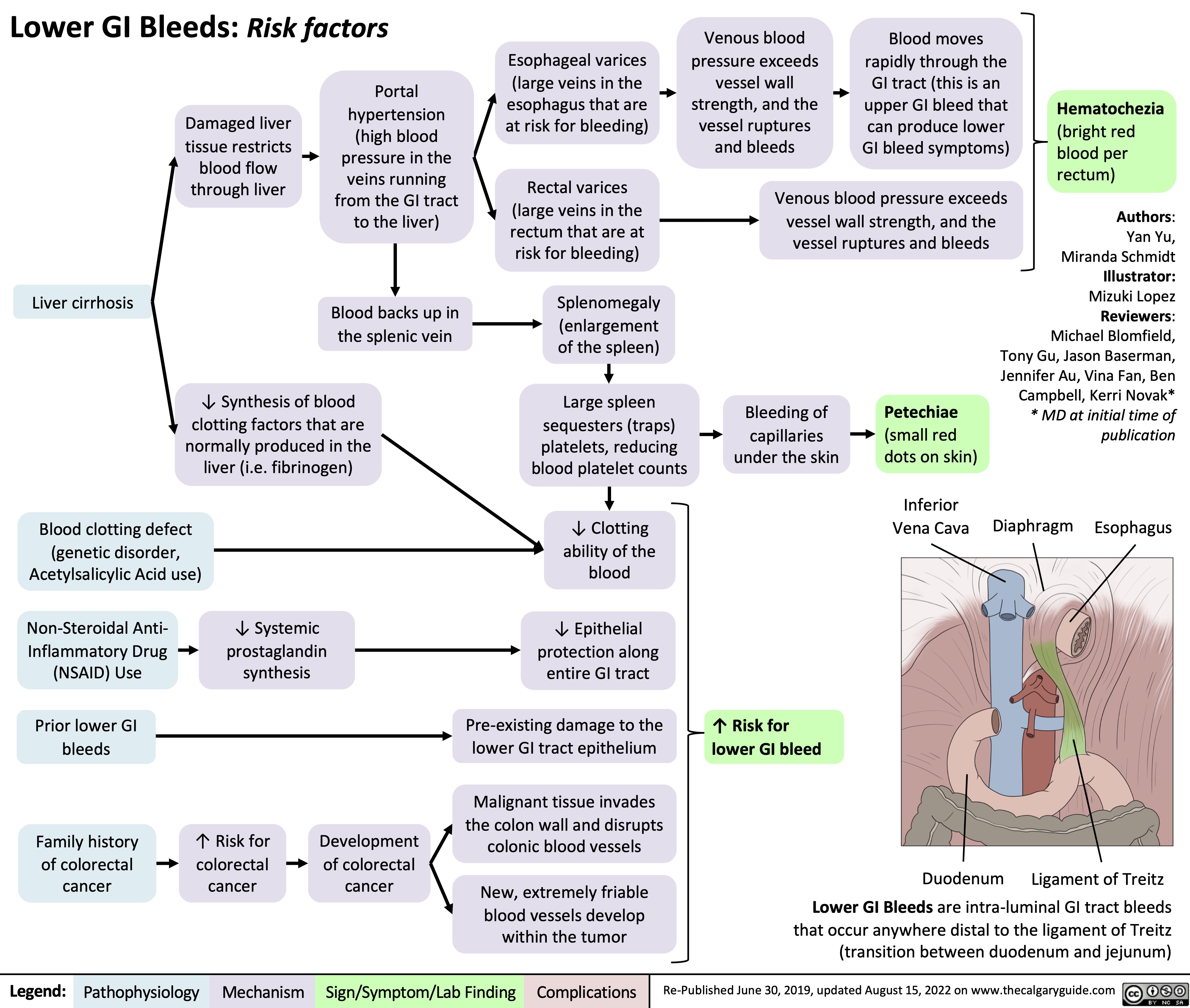 Lower GI Bleeds: Risk factors Portal
Esophageal varices (large veins in the esophagus that are at risk for bleeding)
Rectal varices (large veins in the rectum that are at risk for bleeding)
Splenomegaly (enlargement of the spleen)
Large spleen sequesters (traps) platelets, reducing blood platelet counts
↓ Clotting ability of the blood
↓ Epithelial protection along entire GI tract
Pre-existing damage to the lower GI tract epithelium
Malignant tissue invades the colon wall and disrupts colonic blood vessels
New, extremely friable blood vessels develop within the tumor
Venous blood pressure exceeds vessel wall strength, and the vessel ruptures and bleeds
Blood moves rapidly through the GI tract (this is an upper GI bleed that can produce lower GI bleed symptoms)
Hematochezia
(bright red blood per rectum)
        Damaged liver tissue restricts
blood flow through liver
hypertension (high blood pressure in the veins running from the GI tract to the liver)
Blood backs up in the splenic vein
Venous blood pressure exceeds vessel wall strength, and the vessel ruptures and bleeds
        Liver cirrhosis
Authors: Yan Yu, Miranda Schmidt Illustrator: Mizuki Lopez Reviewers: Michael Blomfield, Tony Gu, Jason Baserman, Jennifer Au, Vina Fan, Ben Campbell, Kerri Novak* * MD at initial time of publication
     ↓ Synthesis of blood clotting factors that are normally produced in the liver (i.e. fibrinogen)
Bleeding of capillaries under the skin
Petechiae
(small red dots on skin)
Inferior Vena Cava
      Blood clotting defect (genetic disorder, Acetylsalicylic Acid use)
Non-Steroidal Anti- Inflammatory Drug (NSAID) Use
Prior lower GI bleeds
Family history of colorectal cancer
Diaphragm
Esophagus
       ↓ Systemic prostaglandin synthesis
   ↑ Risk for lower GI bleed
       ↑ Risk for colorectal cancer
Development of colorectal cancer
Duodenum
Ligament of Treitz
  Lower GI Bleeds are intra-luminal GI tract bleeds that occur anywhere distal to the ligament of Treitz (transition between duodenum and jejunum)
 Legend:
 Pathophysiology
Mechanism
Sign/Symptom/Lab Finding
 Complications
Re-Published June 30, 2019, updated August 15, 2022 on www.thecalgaryguide.com
    