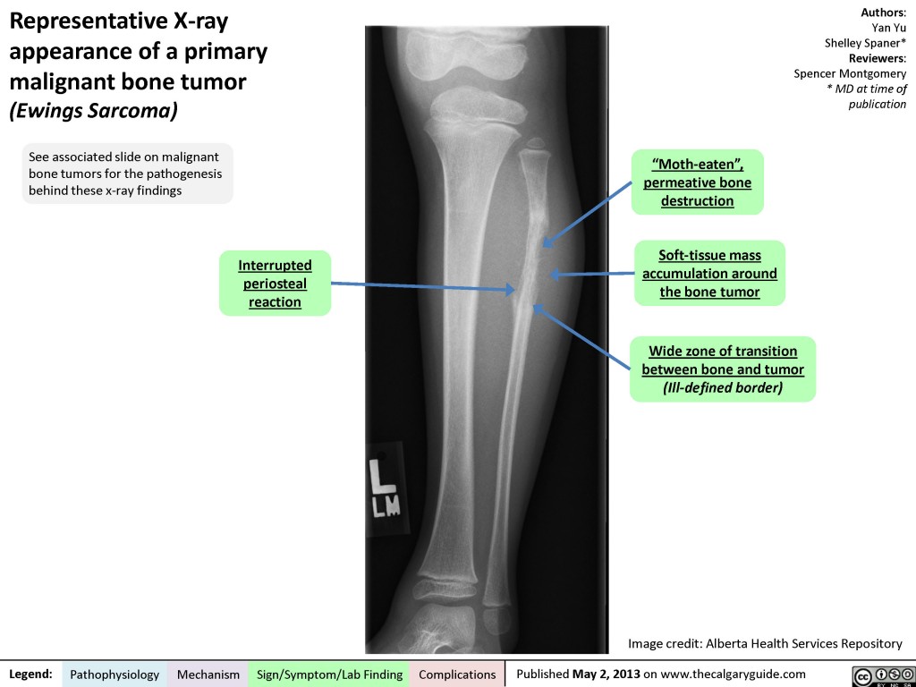 Representative X-ray appearance of a primary malignant bone tumor ...