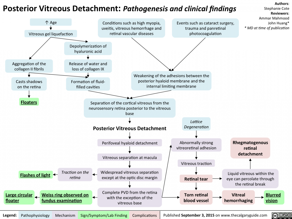 Posterior Vitreous Detachment: Pathogenesis and clinical findings ...