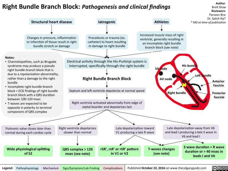 Right Bundle Branch Block: Pathogenesis and clinical findings | Calgary ...