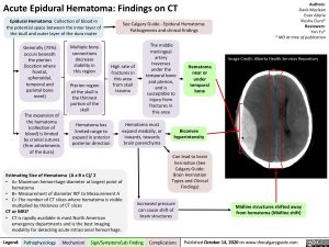Epidural Hematoma: findings on CT