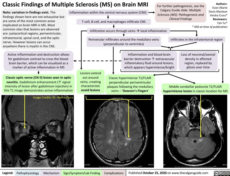 Multiple Sclerosis On Brain MRI Calgary Guide