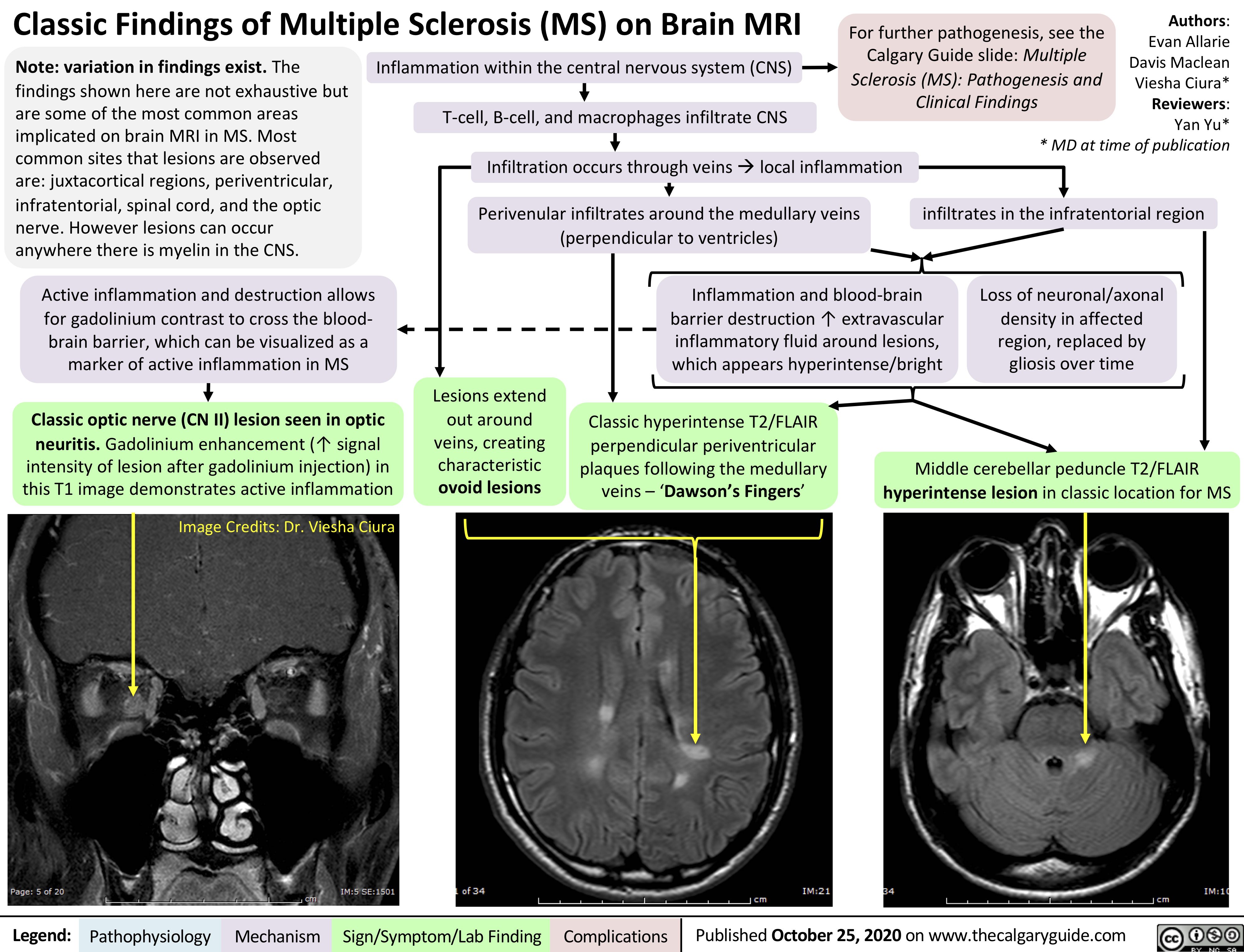 Classic Findings of Multiple Sclerosis (MS) on Brain MRI
Authors: Evan Allarie Davis Maclean Viesha Ciura* Reviewers: Yan Yu* * MD at time of publication
infiltrates in the infratentorial region
   Note: variation in findings exist. The findings shown here are not exhaustive but are some of the most common areas implicated on brain MRI in MS. Most common sites that lesions are observed are: juxtacortical regions, periventricular, infratentorial, spinal cord, and the optic nerve. However lesions can occur anywhere there is myelin in the CNS.
Active inflammation and destruction allows for gadolinium contrast to cross the blood- brain barrier, which can be visualized as a marker of active inflammation in MS
Classic optic nerve (CN II) lesion seen in optic neuritis. Gadolinium enhancement (↑ signal
intensity of lesion after gadolinium injection) in this T1 image demonstrates active inflammation
Image Credits: Dr. Viesha Ciura
For further pathogenesis, see the Calgary Guide slide: Multiple Sclerosis (MS): Pathogenesis and Clinical Findings
Inflammation within the central nervous system (CNS) T-cell, B-cell, and macrophages infiltrate CNS
     Infiltration occurs through veinsàlocal inflammation Perivenular infiltrates around the medullary veins
     (perpendicular to ventricles)
Inflammation and blood-brain barrier destruction ↑ extravascular inflammatory fluid around lesions, which appears hyperintense/bright
Loss of neuronal/axonal density in affected region, replaced by gliosis over time
          Lesions extend out around veins, creating characteristic ovoid lesions
Classic hyperintense T2/FLAIR perpendicular periventricular plaques following the medullary veins – ‘Dawson’s Fingers’
Middle cerebellar peduncle T2/FLAIR hyperintense lesion in classic location for MS
             Legend:
 Pathophysiology
Mechanism
Sign/Symptom/Lab Finding
  Complications
Published October 25, 2020 on www.thecalgaryguide.com
    