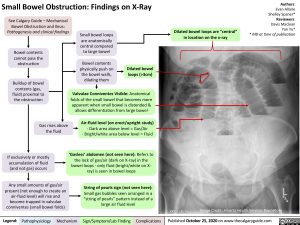 Small Bowel Obstruction: Findings on X-Ray