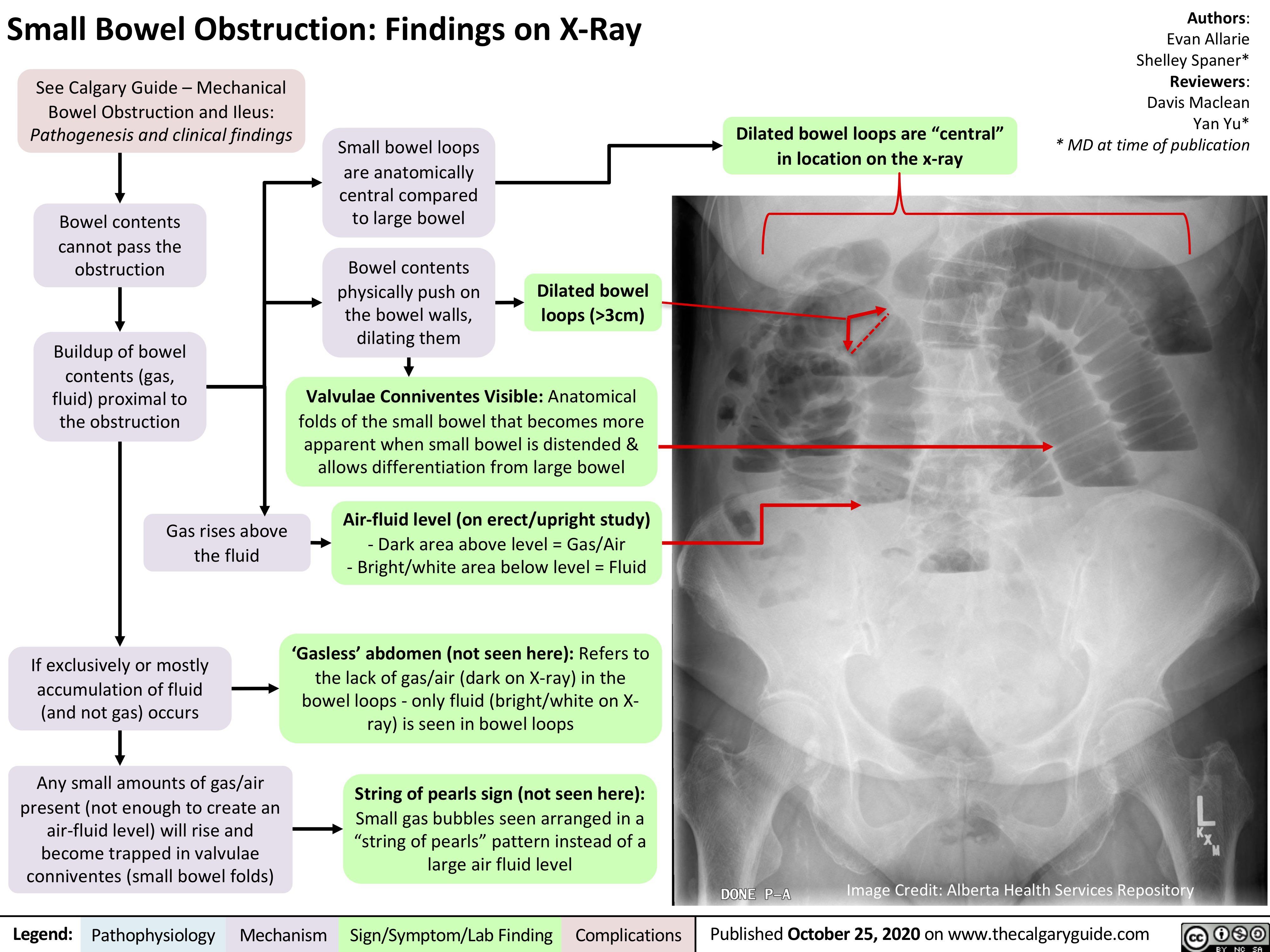 Small Bowel Obstruction: Findings on X-Ray
Authors: Evan Allarie Shelley Spaner* Reviewers: Davis Maclean Yan Yu* * MD at time of publication
 See Calgary Guide – Mechanical Bowel Obstruction and Ileus: Pathogenesis and clinical findings
Bowel contents cannot pass the obstruction
Buildup of bowel contents (gas, fluid) proximal to the obstruction
Gas rises above the fluid
If exclusively or mostly accumulation of fluid (and not gas) occurs
Any small amounts of gas/air present (not enough to create an
air-fluid level) will rise and become trapped in valvulae conniventes (small bowel folds)
Small bowel loops are anatomically
central compared to large bowel
Bowel contents physically push on the bowel walls, dilating them
Dilated bowel loops are “central” in location on the x-ray
          Dilated bowel loops (>3cm)
            Valvulae Conniventes Visible: Anatomical folds of the small bowel that becomes more
apparent when small bowel is distended & allows differentiation from large bowel
Air-fluid level (on erect/upright study)
- Dark area above level = Gas/Air
- Bright/white area below level = Fluid
       ‘Gasless’ abdomen (not seen here): Refers to the lack of gas/air (dark on X-ray) in the bowel loops - only fluid (bright/white on X- ray) is seen in bowel loops
String of pearls sign (not seen here):
Small gas bubbles seen arranged in a “string of pearls” pattern instead of a large air fluid level
      Image Credit: Alberta Health Services Repository
 Legend:
 Pathophysiology
Mechanism
Sign/Symptom/Lab Finding
  Complications
Published October 25, 2020 on www.thecalgaryguide.com
    