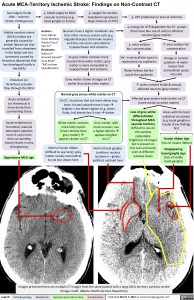 acute-mca-territory-ischemic-stroke-findings-on-non-contrast-ct