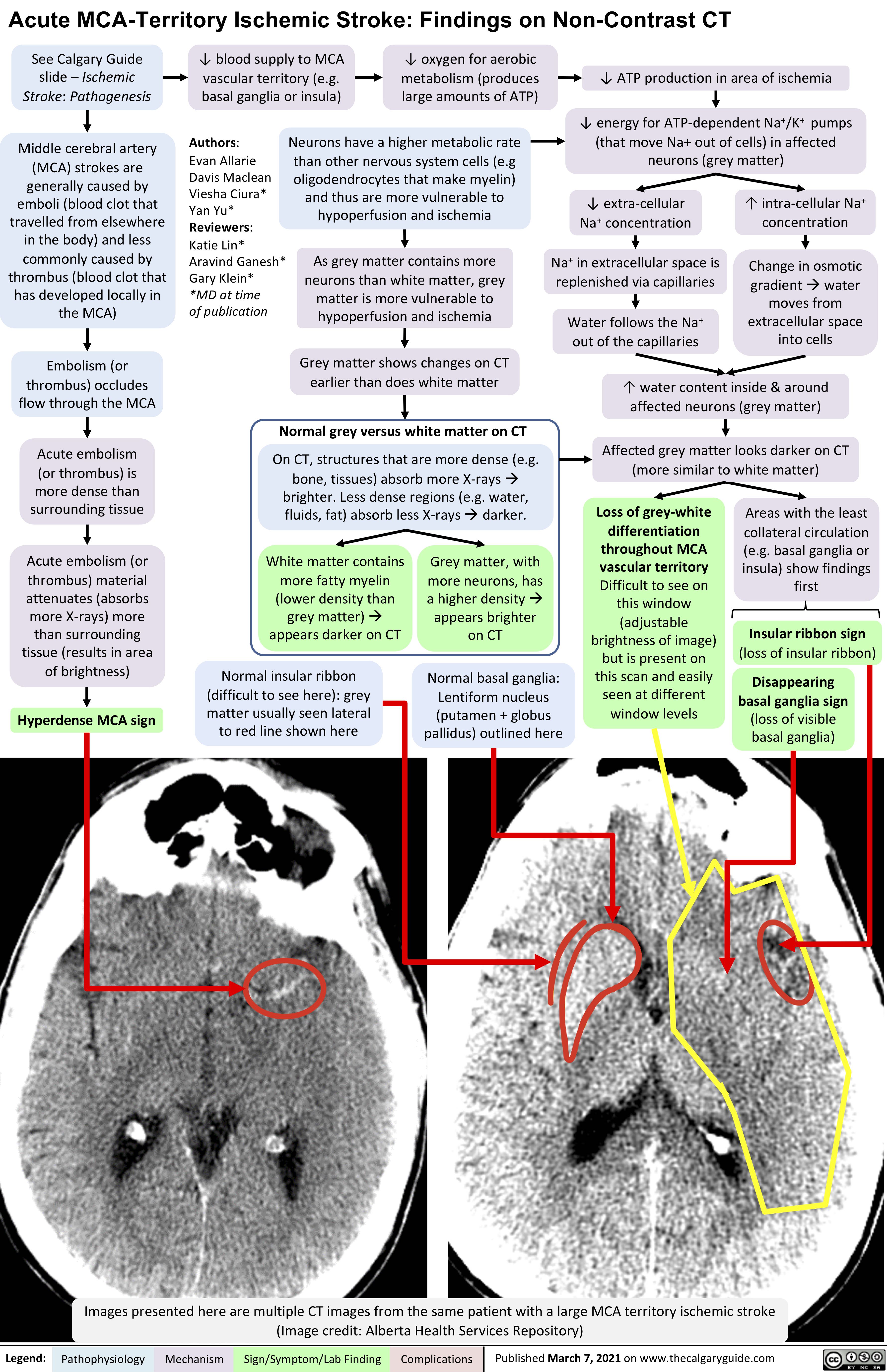 Acute MCA-Territory Ischemic Stroke: Findings on Non-Contrast CT
   See Calgary Guide slide – Ischemic Stroke: Pathogenesis
Middle cerebral artery (MCA) strokes are generally caused by emboli (blood clot that travelled from elsewhere in the body) and less commonly caused by thrombus (blood clot that has developed locally in the MCA)
Embolism (or thrombus) occludes flow through the MCA
Acute embolism
(or thrombus) is more dense than surrounding tissue
Acute embolism (or thrombus) material attenuates (absorbs more X-rays) more than surrounding tissue (results in area of brightness)
Hyperdense MCA sign
↓ blood supply to MCA vascular territory (e.g. basal ganglia or insula)
↓ oxygen for aerobic metabolism (produces large amounts of ATP)
↓ ATP production in area of ischemia
↓ energy for ATP-dependent Na+/K+ pumps (that move Na+ out of cells) in affected neurons (grey matter)
        Neurons have a higher metabolic rate than other nervous system cells (e.g oligodendrocytes that make myelin) and thus are more vulnerable to hypoperfusion and ischemia
As grey matter contains more neurons than white matter, grey matter is more vulnerable to hypoperfusion and ischemia
Grey matter shows changes on CT earlier than does white matter
Normal grey versus white matter on CT
On CT, structures that are more dense (e.g. bone, tissues) absorb more X-raysà brighter. Less dense regions (e.g. water, fluids, fat) absorb less X-raysàdarker.
 Authors:
Evan Allarie Davis Maclean Viesha Ciura* Yan Yu* Reviewers:
Katie Lin* Aravind Ganesh* Gary Klein*
*MD at time
of publication
↓ extra-cellular Na+ concentration
Na+ in extracellular space is replenished via capillaries
Water follows the Na+ out of the capillaries
↑ intra-cellular Na+ concentration
Change in osmotic gradientàwater moves from extracellular space into cells
                   ↑ water content inside & around affected neurons (grey matter)
Affected grey matter looks darker on CT (more similar to white matter)
                 White matter contains more fatty myelin (lower density than grey matter)à appears darker on CT
Normal insular ribbon (difficult to see here): grey matter usually seen lateral to red line shown here
Grey matter, with more neurons, has a higher densityà appears brighter on CT
Normal basal ganglia: Lentiform nucleus (putamen + globus pallidus) outlined here
Loss of grey-white differentiation throughout MCA vascular territory Difficult to see on this window (adjustable brightness of image) but is present on this scan and easily seen at different window levels
Areas with the least collateral circulation
(e.g. basal ganglia or insula) show findings first
Insular ribbon sign
(loss of insular ribbon)
Disappearing basal ganglia sign (loss of visible basal ganglia)
                Comparison to normal anatomy helps outline pathologic findings
 Comparison to normal anatomy helps outline pathologic findings
 Images presented here are multiple CT images from the same patient with a large MCA territory ischemic stroke (Image credit: Alberta Health Services Repository)
 Legend:
 Pathophysiology
 Mechanism
 Sign/Symptom/Lab Finding
  Complications
 Published March 7, 2021 on www.thecalgaryguide.com
 