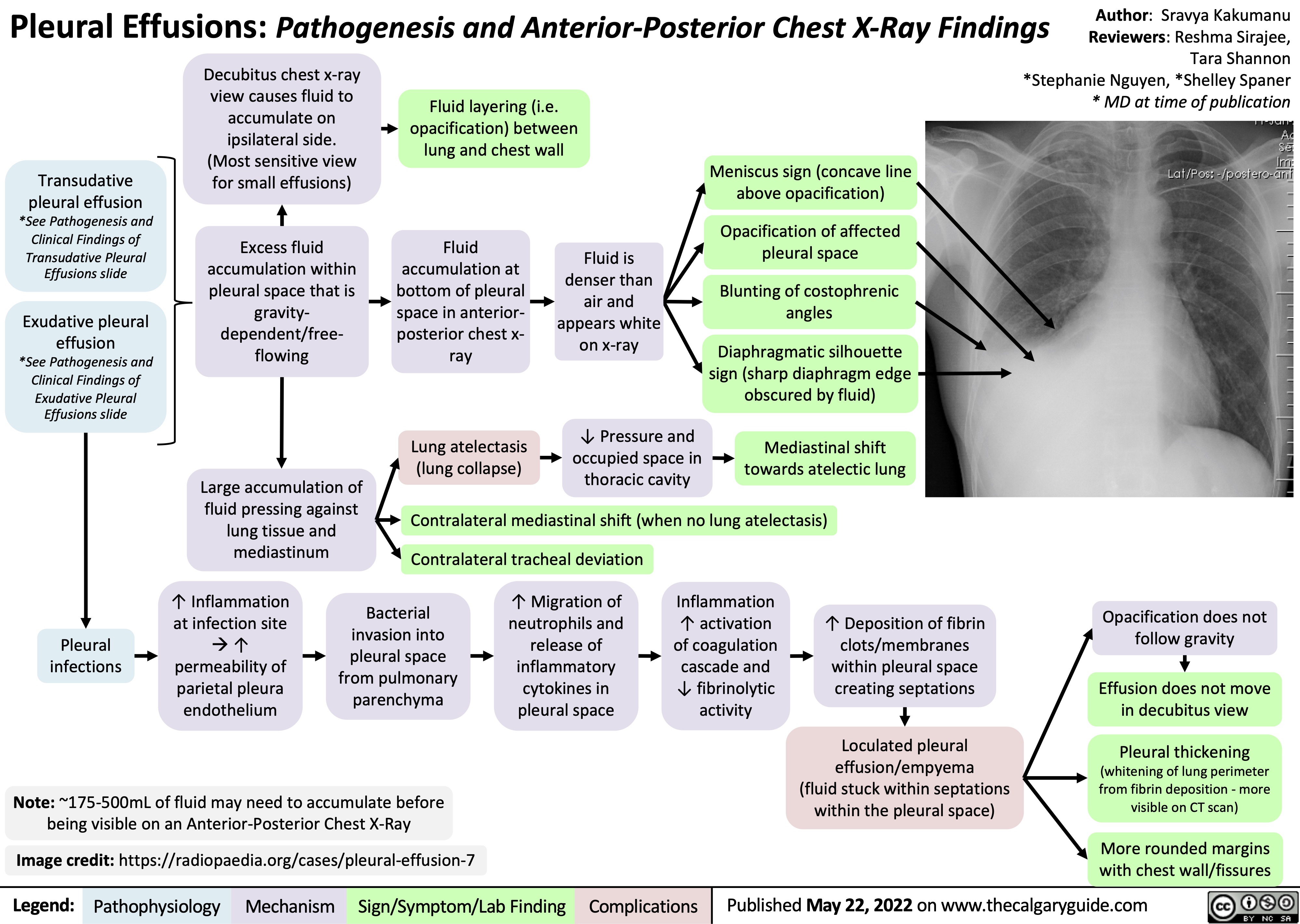 Pleural Effusions: Pathogenesis and Anterior-Posterior Chest X-Ray Findings
 Decubitus chest x-ray view causes fluid to accumulate on ipsilateral side. (Most sensitive view for small effusions)
Excess fluid accumulation within pleural space that is gravity- dependent/free- flowing
Large accumulation of fluid pressing against lung tissue and mediastinum
Fluid layering (i.e. opacification) between lung and chest wall
Author: Sravya Kakumanu Reviewers: Reshma Sirajee, Tara Shannon *Stephanie Nguyen, *Shelley Spaner * MD at time of publication
     Transudative
pleural effusion
*See Pathogenesis and Clinical Findings of
Transudative Pleural Effusions slide
Exudative pleural
effusion
*See Pathogenesis and Clinical Findings of
Exudative Pleural Effusions slide
Fluid accumulation at bottom of pleural space in anterior- posterior chest x- ray
Lung atelectasis (lung collapse)
Fluid is denser than air and appears white on x-ray
↓ Pressure and occupied space in thoracic cavity
Meniscus sign (concave line above opacification)
Opacification of affected pleural space
Blunting of costophrenic angles
Diaphragmatic silhouette sign (sharp diaphragm edge obscured by fluid)
Mediastinal shift towards atelectic lung
                      Contralateral mediastinal shift (when no lung atelectasis)
 Contralateral tracheal deviation
        Pleural infections
↑ Inflammation at infection site à↑ permeability of parietal pleura endothelium
Bacterial invasion into pleural space from pulmonary parenchyma
↑ Migration of neutrophils and release of inflammatory cytokines in pleural space
Inflammation ↑ activation of coagulation cascade and ↓ fibrinolytic activity
↑ Deposition of fibrin clots/membranes within pleural space creating septations
Loculated pleural effusion/empyema (fluid stuck within septations within the pleural space)
Opacification does not follow gravity
Effusion does not move in decubitus view
Pleural thickening (whitening of lung perimeter from fibrin deposition - more visible on CT scan)
More rounded margins with chest wall/fissures
    Note: ~175-500mL of fluid may need to accumulate before being visible on an Anterior-Posterior Chest X-Ray
Image credit: https://radiopaedia.org/cases/pleural-effusion-7
   Legend:
 Pathophysiology
 Mechanism
Sign/Symptom/Lab Finding
 Complications
 Published May 22, 2022 on www.thecalgaryguide.com
  