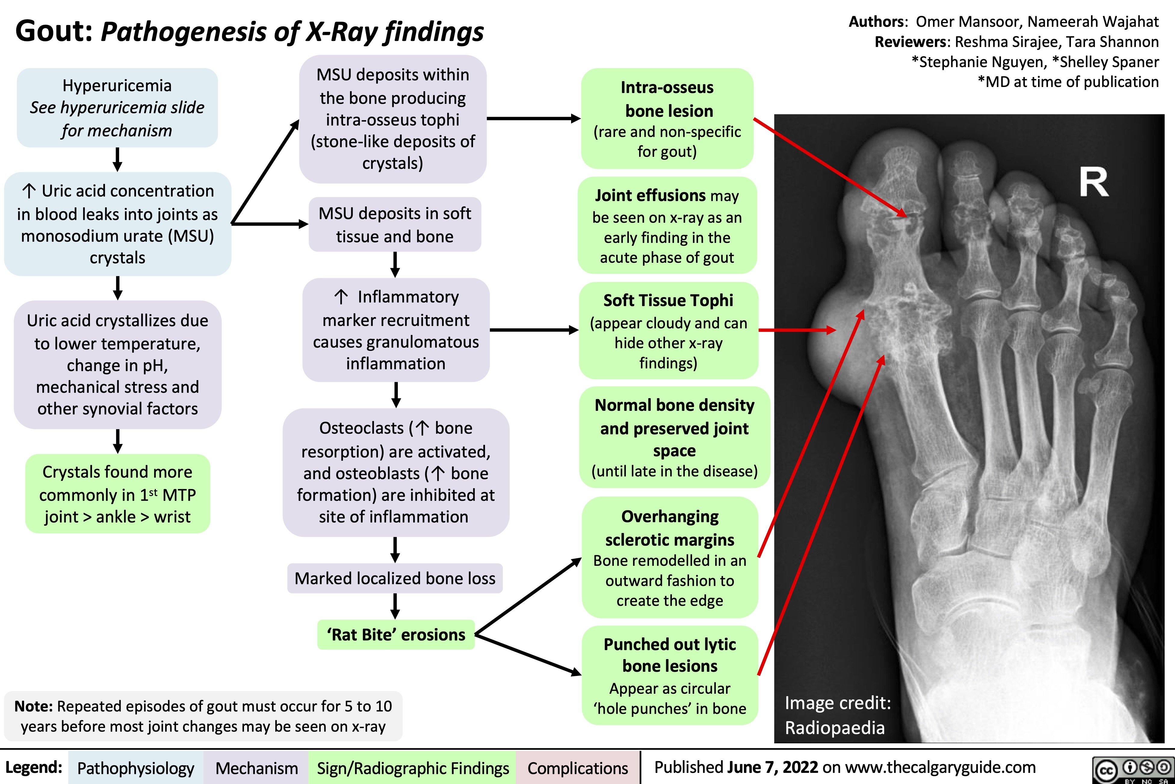 Gout: Pathogenesis of X-Ray findings
Authors: Omer Mansoor, Nameerah Wajahat Reviewers: Reshma Sirajee, Tara Shannon *Stephanie Nguyen, *Shelley Spaner *MD at time of publication
   Hyperuricemia
See hyperuricemia slide for mechanism
↑ Uric acid concentration in blood leaks into joints as monosodium urate (MSU) crystals
Uric acid crystallizes due to lower temperature, change in pH, mechanical stress and other synovial factors
Crystals found more commonly in 1st MTP joint > ankle > wrist
MSU deposits within the bone producing
intra-osseus tophi (stone-like deposits of crystals)
MSU deposits in soft tissue and bone
↑ Inflammatory marker recruitment causes granulomatous inflammation
Osteoclasts (↑ bone resorption) are activated, and osteoblasts (↑ bone formation) are inhibited at
site of inflammation Marked localized bone loss
‘Rat Bite’ erosions
Intra-osseus bone lesion
(rare and non-specific for gout)
Joint effusions may be seen on x-ray as an early finding in the acute phase of gout
Soft Tissue Tophi
(appear cloudy and can hide other x-ray findings)
Normal bone density and preserved joint space
(until late in the disease)
Overhanging
sclerotic margins
Bone remodelled in an outward fashion to create the edge
Punched out lytic bone lesions Appear as circular ‘hole punches’ in bone
                        Note: Repeated episodes of gout must occur for 5 to 10 years before most joint changes may be seen on x-ray
Image credit: Radiopaedia
 Legend:
 Pathophysiology
Mechanism
Sign/Radiographic Findings
 Complications
Published June 7, 2022 on www.thecalgaryguide.com
    