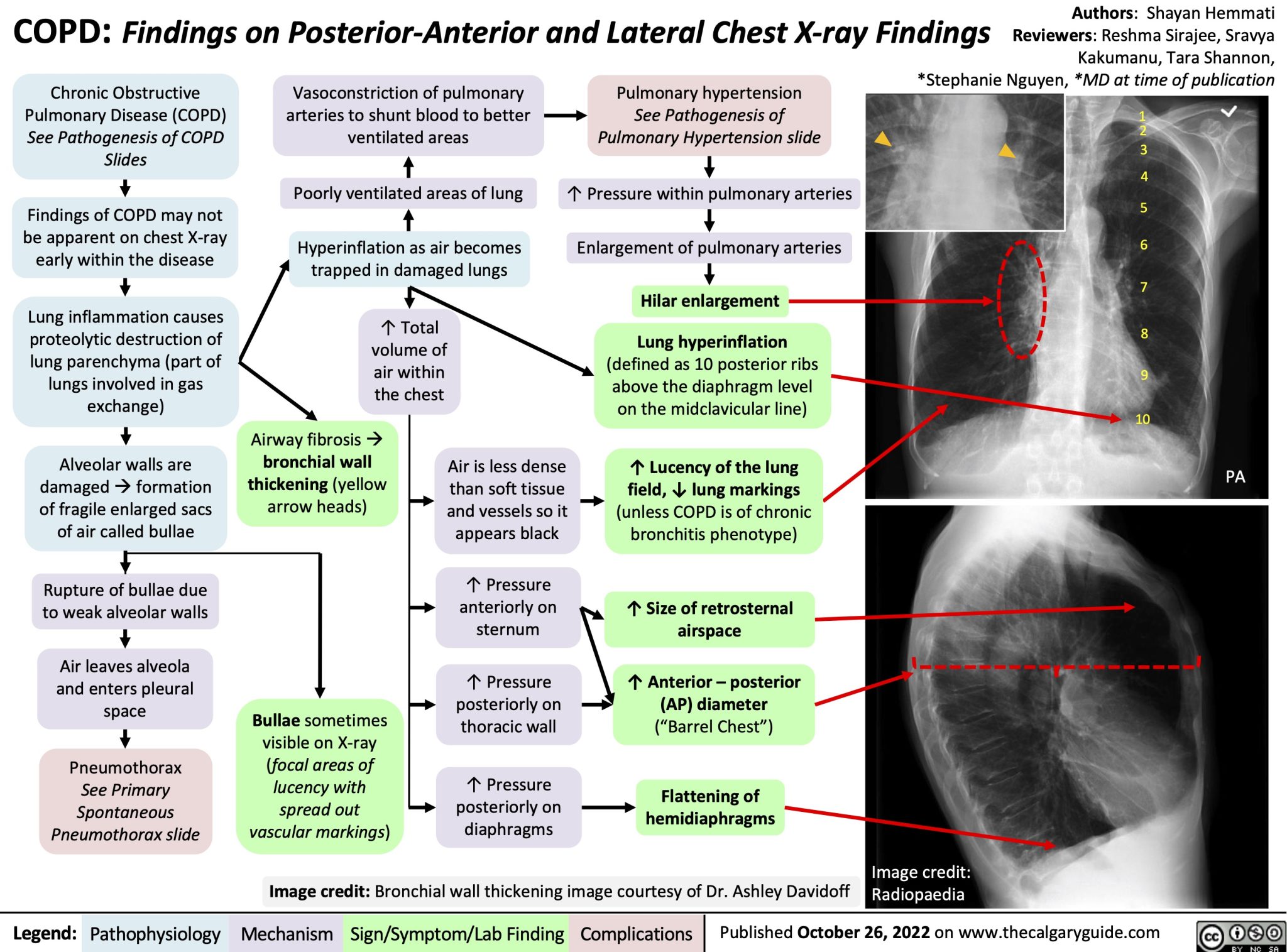 copd-findings-on-posterior-anterior-and-lateral-chest-x-ray-findings