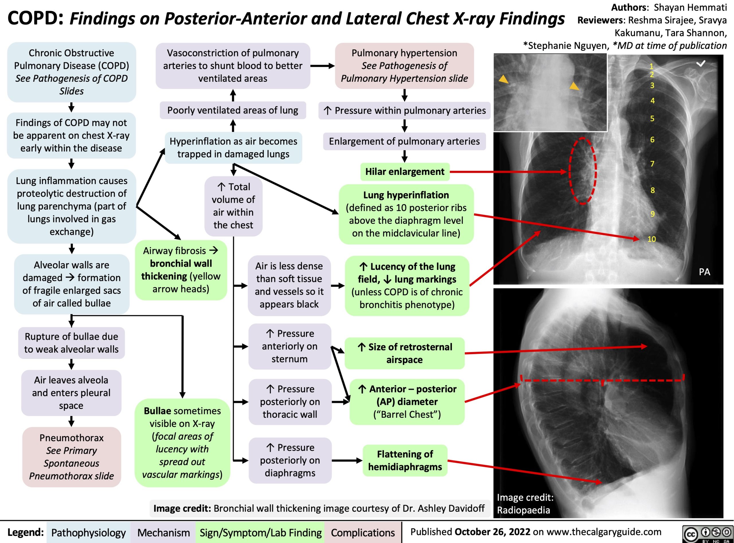 COPD Findings on PosteriorAnterior and Lateral Chest Xray Findings