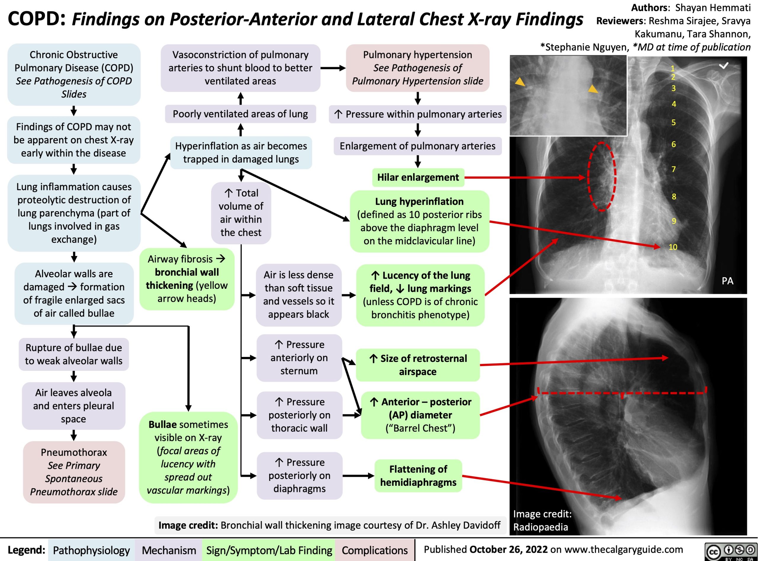 COPD Findings On Posterior Anterior And Lateral Chest X ray Findings 