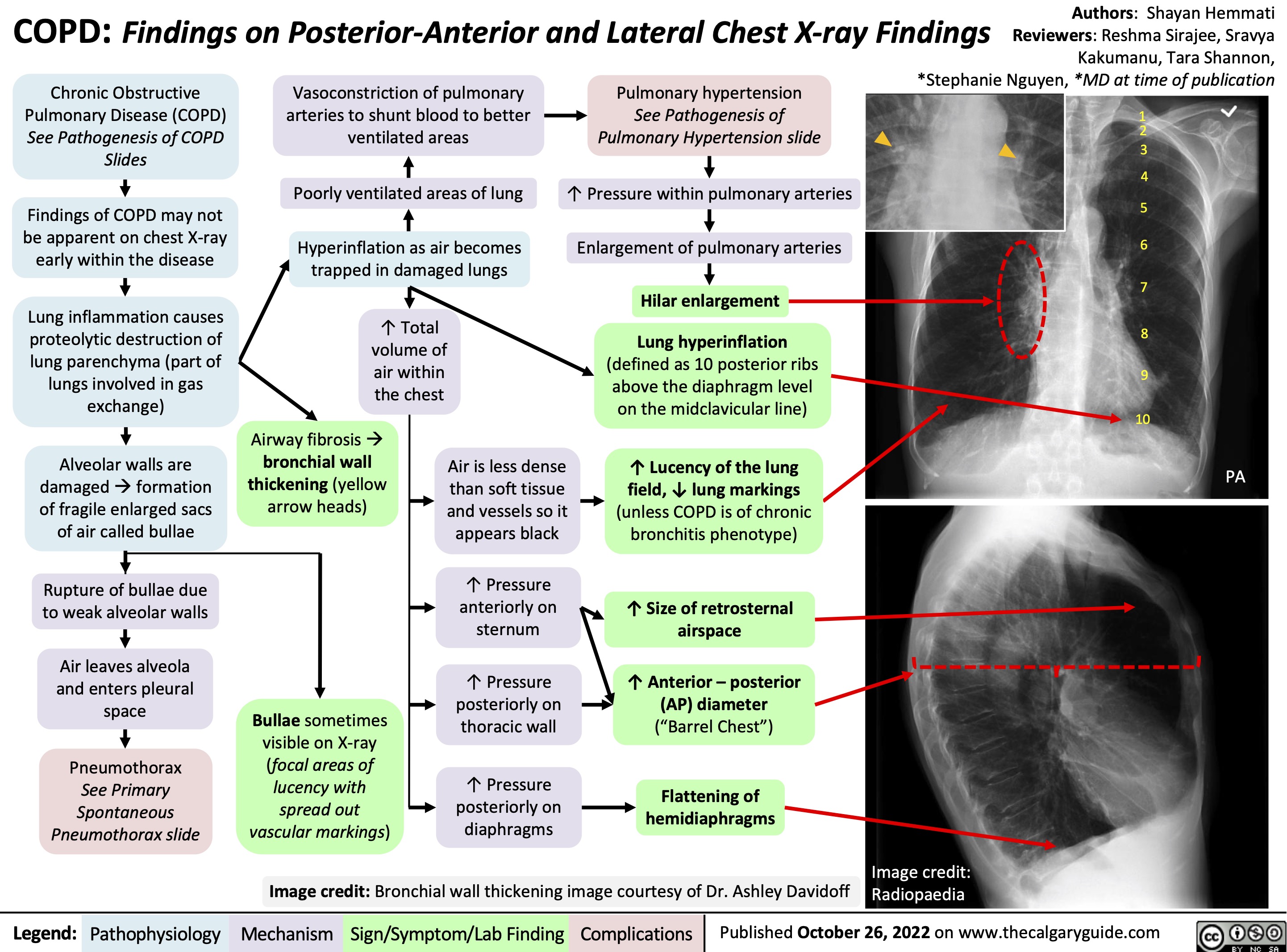 Authors: Shayan Hemmati COPD: Findings on Posterior-Anterior and Lateral Chest X-ray Findings Reviewers: Reshma Sirajee, Sravya Kakumanu, Tara Shannon, *Stephanie Nguyen, *MD at time of publication
   Chronic Obstructive Pulmonary Disease (COPD) See Pathogenesis of COPD Slides
Findings of COPD may not be apparent on chest X-ray early within the disease
Lung inflammation causes proteolytic destruction of lung parenchyma (part of lungs involved in gas exchange)
Alveolar walls are damagedàformation of fragile enlarged sacs of air called bullae
Rupture of bullae due to weak alveolar walls
Air leaves alveola and enters pleural space
Pneumothorax
See Primary Spontaneous Pneumothorax slide
Vasoconstriction of pulmonary arteries to shunt blood to better ventilated areas
Pulmonary hypertension
See Pathogenesis of Pulmonary Hypertension slide
↑ Pressure within pulmonary arteries
Enlargement of pulmonary arteries
Hilar enlargement Lung hyperinflation
(defined as 10 posterior ribs above the diaphragm level on the midclavicular line)
↑ Lucency of the lung
field, ↓ lung markings
(unless COPD is of chronic bronchitis phenotype)
↑ Size of retrosternal airspace
↑ Anterior – posterior (AP) diameter (“Barrel Chest”)
Flattening of hemidiaphragms
12 3 4
5 6
7
8
9 10
    Poorly ventilated areas of lung
Hyperinflation as air becomes trapped in damaged lungs
↑ Total volume of air within the chest
                Airway fibrosisà bronchial wall thickening (yellow arrow heads)
Air is less dense than soft tissue and vessels so it appears black
↑ Pressure anteriorly on sternum
↑ Pressure posteriorly on thoracic wall
↑ Pressure posteriorly on diaphragms
PA
                Bullae sometimes visible on X-ray (focal areas of lucency with spread out vascular markings)
     Image credit: Bronchial wall thickening image courtesy of Dr. Ashley Davidoff
Image credit: Radiopaedia
 Legend:
 Pathophysiology
Mechanism
Sign/Symptom/Lab Finding
 Complications
Published October 26, 2022 on www.thecalgaryguide.com
    