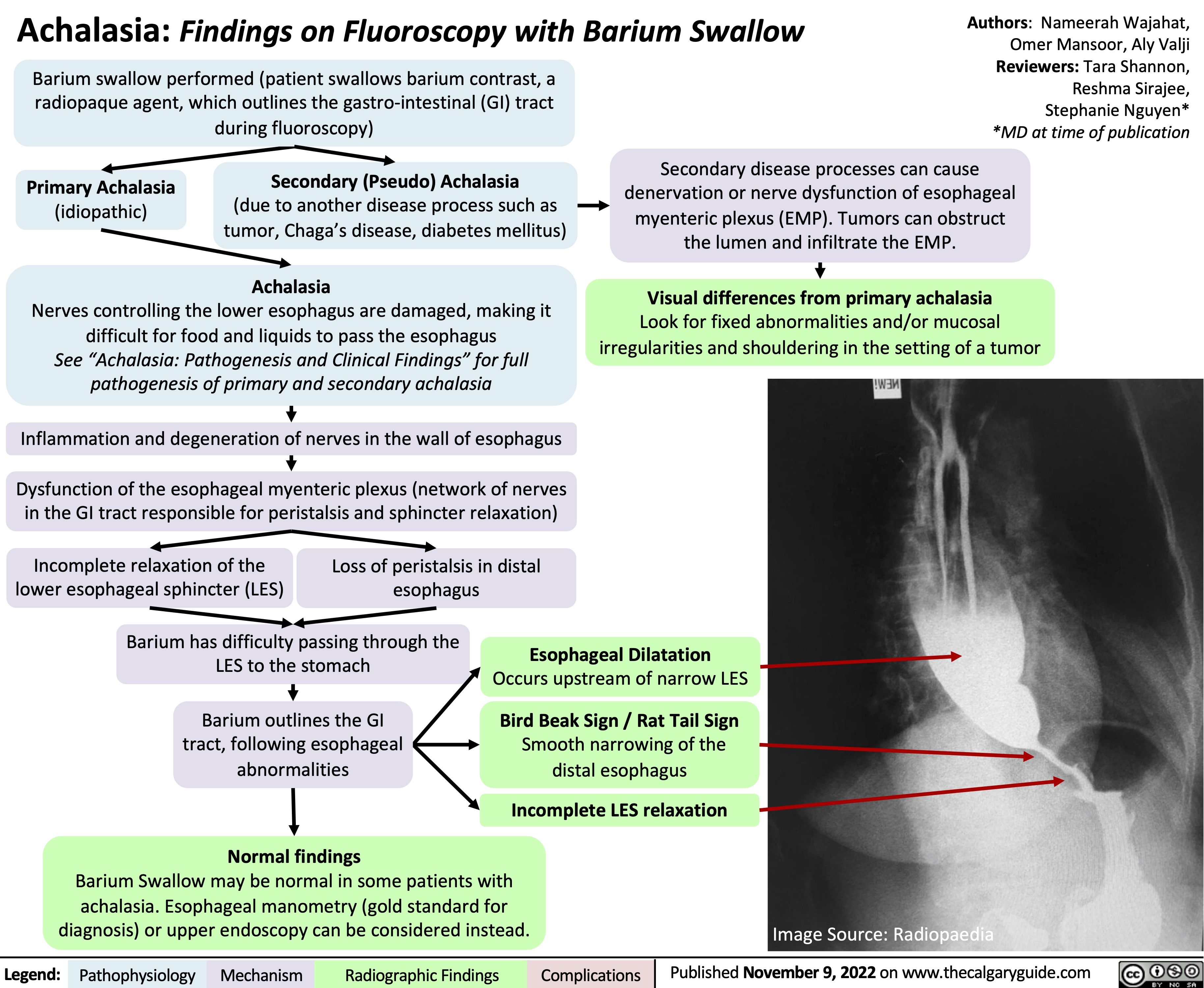 Achalasia: Findings on Fluoroscopy with Barium Swallow
Authors: Nameerah Wajahat, Omer Mansoor, Aly Valji Reviewers: Tara Shannon, Reshma Sirajee, Stephanie Nguyen* *MD at time of publication
 Barium swallow performed (patient swallows barium contrast, a radiopaque agent, which outlines the gastro-intestinal (GI) tract during fluoroscopy)
    Primary Achalasia
(idiopathic)
Secondary (Pseudo) Achalasia
(due to another disease process such as tumor, Chaga’s disease, diabetes mellitus)
Achalasia
Secondary disease processes can cause denervation or nerve dysfunction of esophageal myenteric plexus (EMP). Tumors can obstruct the lumen and infiltrate the EMP.
Visual differences from primary achalasia
Look for fixed abnormalities and/or mucosal irregularities and shouldering in the setting of a tumor
   Nerves controlling the lower esophagus are damaged, making it difficult for food and liquids to pass the esophagus
See “Achalasia: Pathogenesis and Clinical Findings” for full pathogenesis of primary and secondary achalasia
Inflammation and degeneration of nerves in the wall of esophagus
Dysfunction of the esophageal myenteric plexus (network of nerves in the GI tract responsible for peristalsis and sphincter relaxation)
Incomplete relaxation of the Loss of peristalsis in distal lower esophageal sphincter (LES) esophagus
          Barium has difficulty passing through the LES to the stomach
Barium outlines the GI tract, following esophageal abnormalities
Normal findings
Esophageal Dilatation
Occurs upstream of narrow LES
Bird Beak Sign / Rat Tail Sign
Smooth narrowing of the distal esophagus
Incomplete LES relaxation
        Barium Swallow may be normal in some patients with achalasia. Esophageal manometry (gold standard for diagnosis) or upper endoscopy can be considered instead.
Image Source: Radiopaedia
 Legend:
 Pathophysiology
Mechanism
Radiographic Findings
 Complications
Published November 9, 2022 on www.thecalgaryguide.com
    