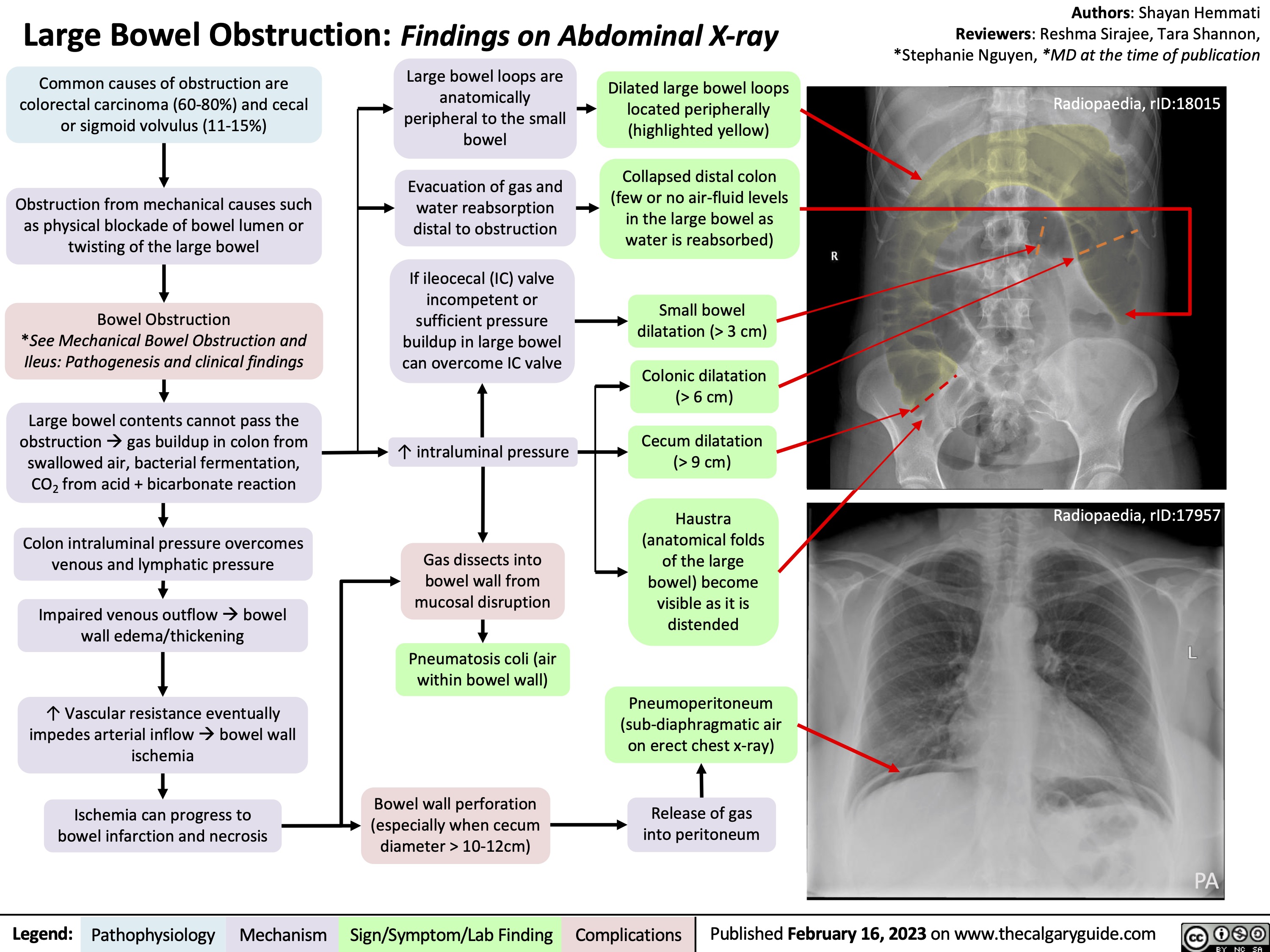 Large Bowel Obstruction: Findings on Abdominal X-ray
Authors: Shayan Hemmati Reviewers: Reshma Sirajee, Tara Shannon, *Stephanie Nguyen, *MD at the time of publication
Radiopaedia, rID:18015
   Common causes of obstruction are colorectal carcinoma (60-80%) and cecal or sigmoid volvulus (11-15%)
Obstruction from mechanical causes such as physical blockade of bowel lumen or twisting of the large bowel
Bowel Obstruction
*See Mechanical Bowel Obstruction and Ileus: Pathogenesis and clinical findings
Large bowel contents cannot pass the obstructionàgas buildup in colon from swallowed air, bacterial fermentation, CO2 from acid + bicarbonate reaction
Colon intraluminal pressure overcomes venous and lymphatic pressure
Impaired venous outflowàbowel wall edema/thickening
↑ Vascular resistance eventually impedes arterial inflowàbowel wall ischemia
Ischemia can progress to bowel infarction and necrosis
Large bowel loops are anatomically peripheral to the small bowel
Evacuation of gas and water reabsorption distal to obstruction
If ileocecal (IC) valve incompetent or sufficient pressure buildup in large bowel can overcome IC valve
↑ intraluminal pressure
Gas dissects into
bowel wall from mucosal disruption
Pneumatosis coli (air within bowel wall)
Bowel wall perforation (especially when cecum diameter > 10-12cm)
Dilated large bowel loops located peripherally (highlighted yellow)
Collapsed distal colon (few or no air-fluid levels in the large bowel as water is reabsorbed)
Small bowel dilatation (> 3 cm)
Colonic dilatation (> 6 cm)
Cecum dilatation (> 9 cm)
Haustra (anatomical folds of the large bowel) become visible as it is distended
Pneumoperitoneum (sub-diaphragmatic air on erect chest x-ray)
Release of gas into peritoneum
PA
Radiopaedia, rID:17957
                                    PA
 Legend:
 Pathophysiology
Mechanism
Sign/Symptom/Lab Finding
 Complications
Published February 16, 2023 on www.thecalgaryguide.com
    