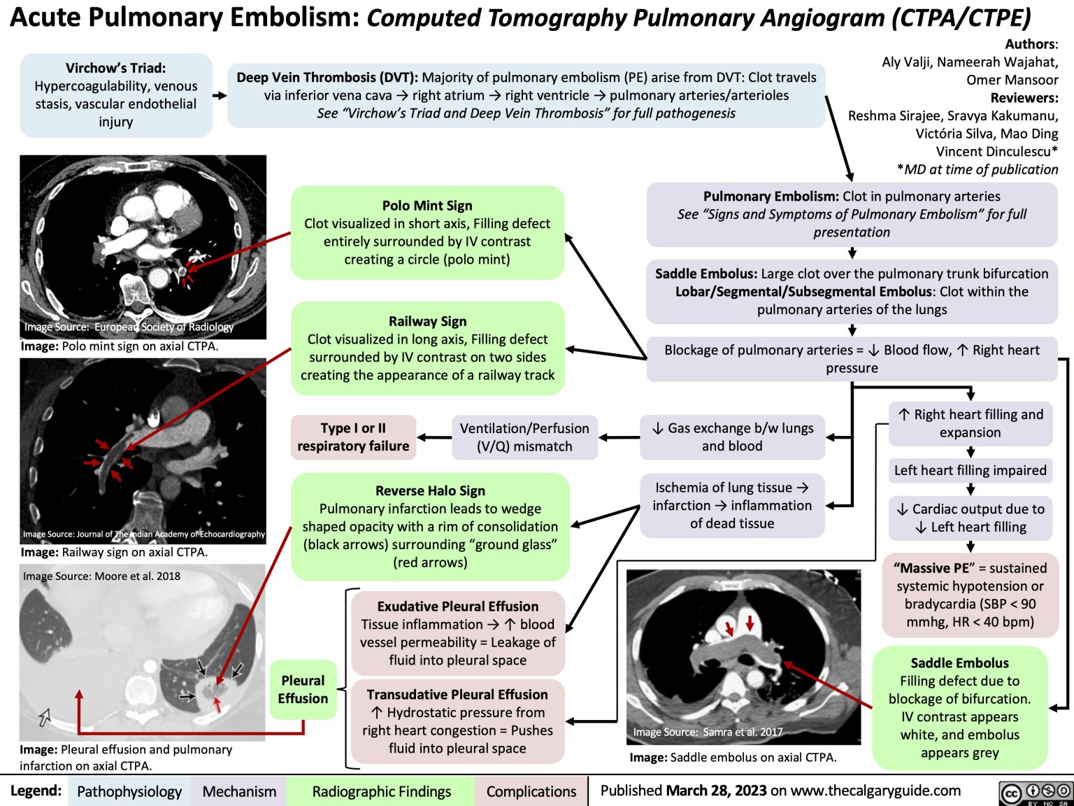 Acute Pulmonary Embolism on CTPA | Calgary Guide