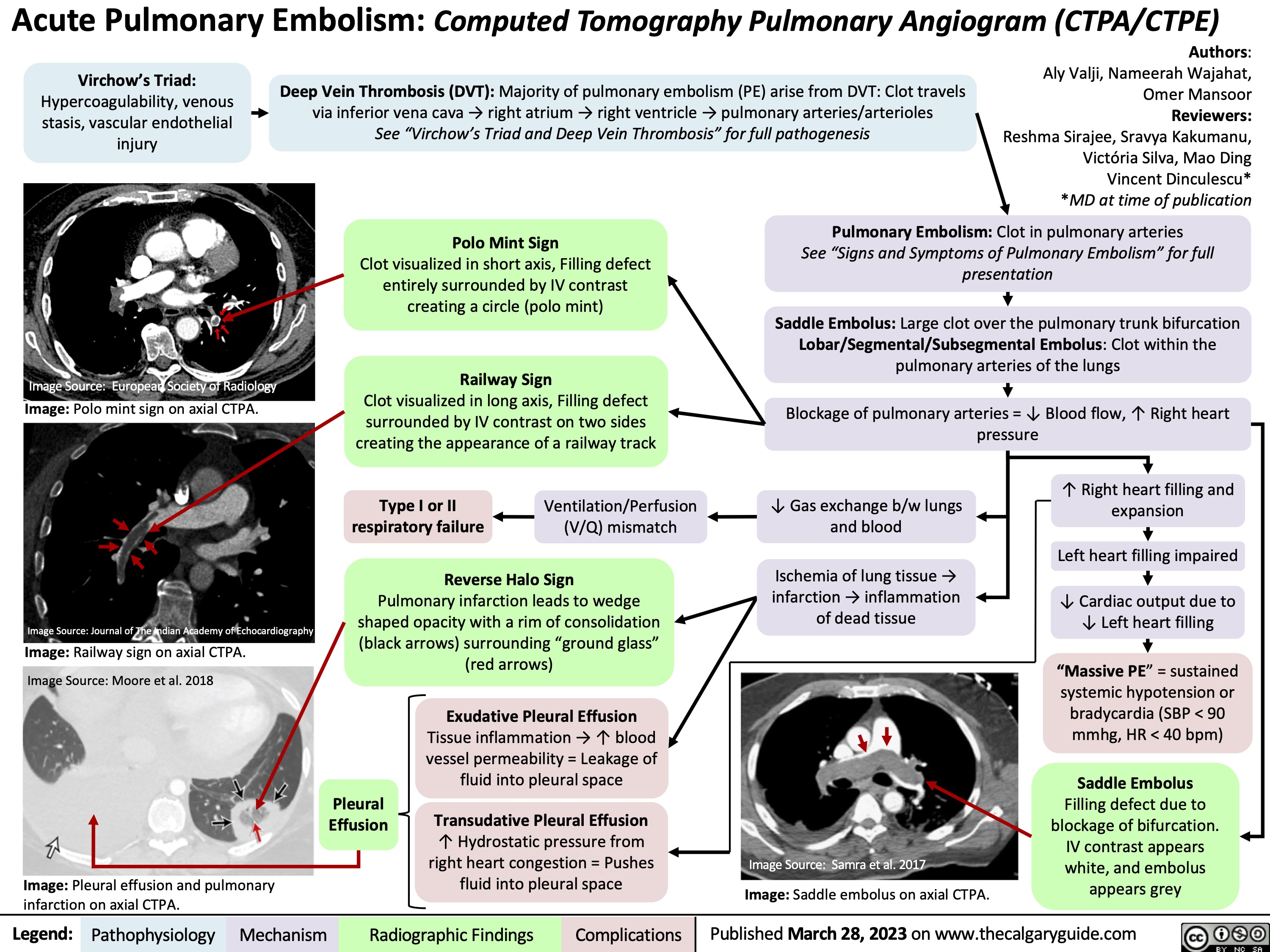 Acute Pulmonary Embolism: Computed Tomography Pulmonary Angiogram (CTPA/CTPE)
 Virchow’s Triad:
Hypercoagulability, venous stasis, vascular endothelial injury
Image Source: European Society of Radiology
Image: Polo mint sign on axial CTPA.
Image Source: Journal of The Indian Academy of Echocardiography
Image: Railway sign on axial CTPA. Image Source: Moore et al. 2018
Image: Pleural effusion and pulmonary infarction on axial CTPA.
Authors: Aly Valji, Nameerah Wajahat, Omer Mansoor Reviewers: Reshma Sirajee, Sravya Kakumanu, Victória Silva, Mao Ding Vincent Dinculescu* *MD at time of publication
 Deep Vein Thrombosis (DVT): Majority of pulmonary embolism (PE) arise from DVT: Clot travels via inferior vena cava → right atrium → right ventricle → pulmonary arteries/arterioles
See “Virchow’s Triad and Deep Vein Thrombosis” for full pathogenesis
    Polo Mint Sign
Clot visualized in short axis, Filling defect entirely surrounded by IV contrast creating a circle (polo mint)
Railway Sign
Clot visualized in long axis, Filling defect surrounded by IV contrast on two sides creating the appearance of a railway track
Type I or II Ventilation/Perfusion respiratory failure (V/Q) mismatch
Reverse Halo Sign
Pulmonary infarction leads to wedge shaped opacity with a rim of consolidation (black arrows) surrounding “ground glass” (red arrows)
Pulmonary Embolism: Clot in pulmonary arteries
See “Signs and Symptoms of Pulmonary Embolism” for full presentation
Saddle Embolus: Large clot over the pulmonary trunk bifurcation Lobar/Segmental/Subsegmental Embolus: Clot within the pulmonary arteries of the lungs
Blockage of pulmonary arteries = ↓ Blood flow, ↑ Right heart pressure
              ↓ Gas exchange b/w lungs and blood
Ischemia of lung tissue → infarction → inflammation of dead tissue
↑ Right heart filling and expansion
Left heart filling impaired
↓ Cardiac output due to ↓ Left heart filling
“Massive PE” = sustained systemic hypotension or bradycardia (SBP < 90 mmhg, HR < 40 bpm)
Saddle Embolus
Filling defect due to blockage of bifurcation. IV contrast appears white, and embolus appears grey
               Pleural Effusion
Exudative Pleural Effusion
Tissue inflammation → ↑ blood vessel permeability = Leakage of fluid into pleural space
Transudative Pleural Effusion
↑ Hydrostatic pressure from right heart congestion = Pushes fluid into pleural space
  Image Source: Samra et al. 2017
Image: Saddle embolus on axial CTPA.
 Legend:
 Pathophysiology
Mechanism
Radiographic Findings
 Complications
Published March 28, 2023 on www.thecalgaryguide.com
    