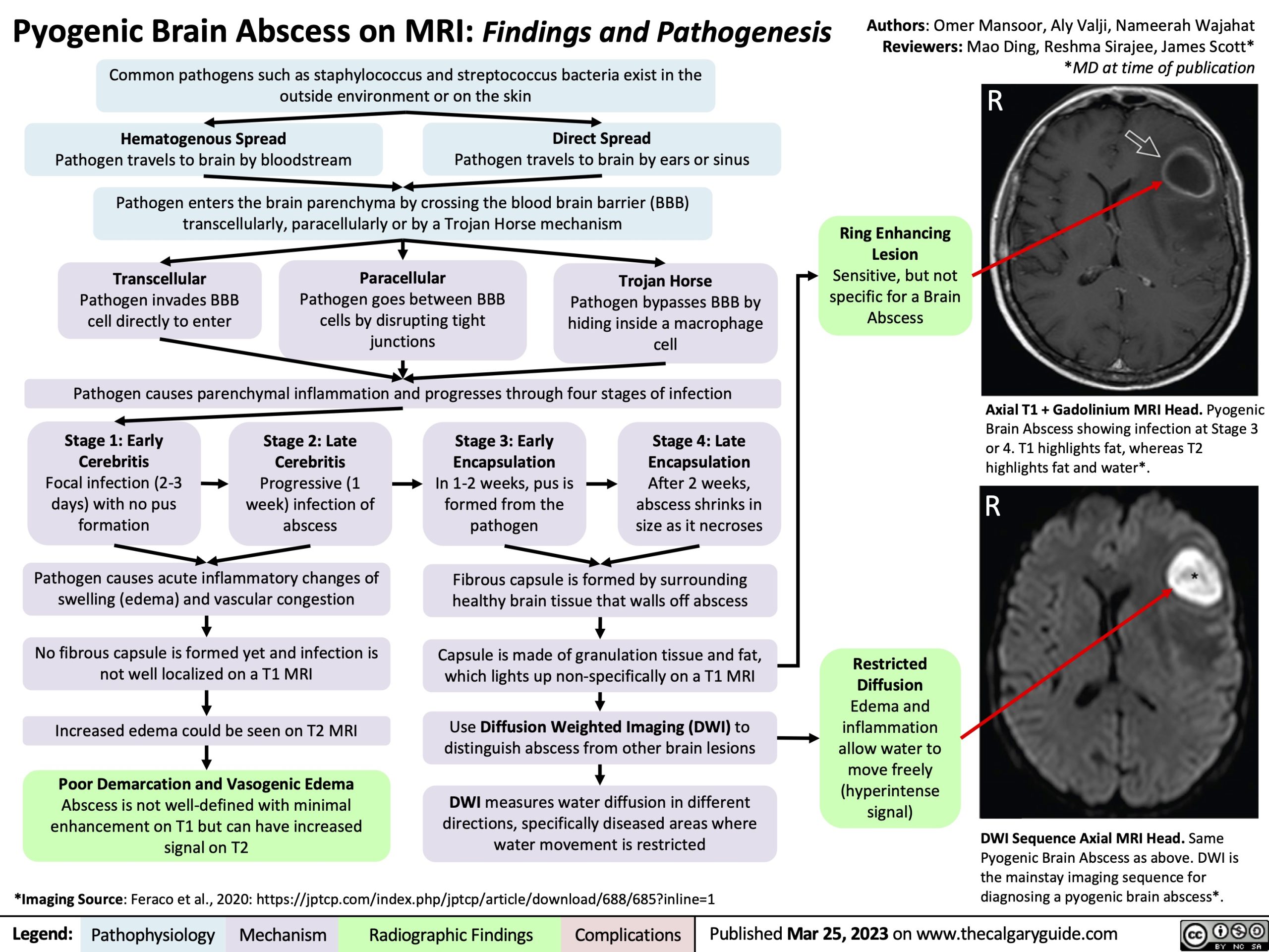 Pyogenic Brain Abscess on MRI