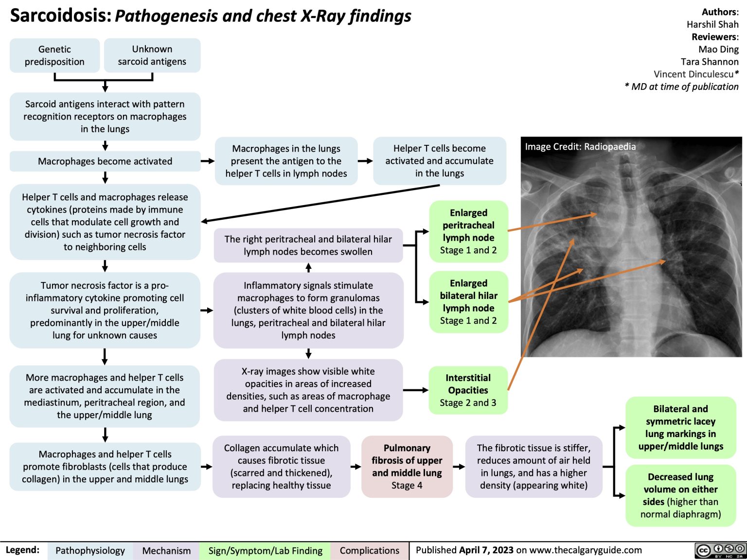 Sarcoidosis: Pathogenesis and CXR Findings | Calgary Guide