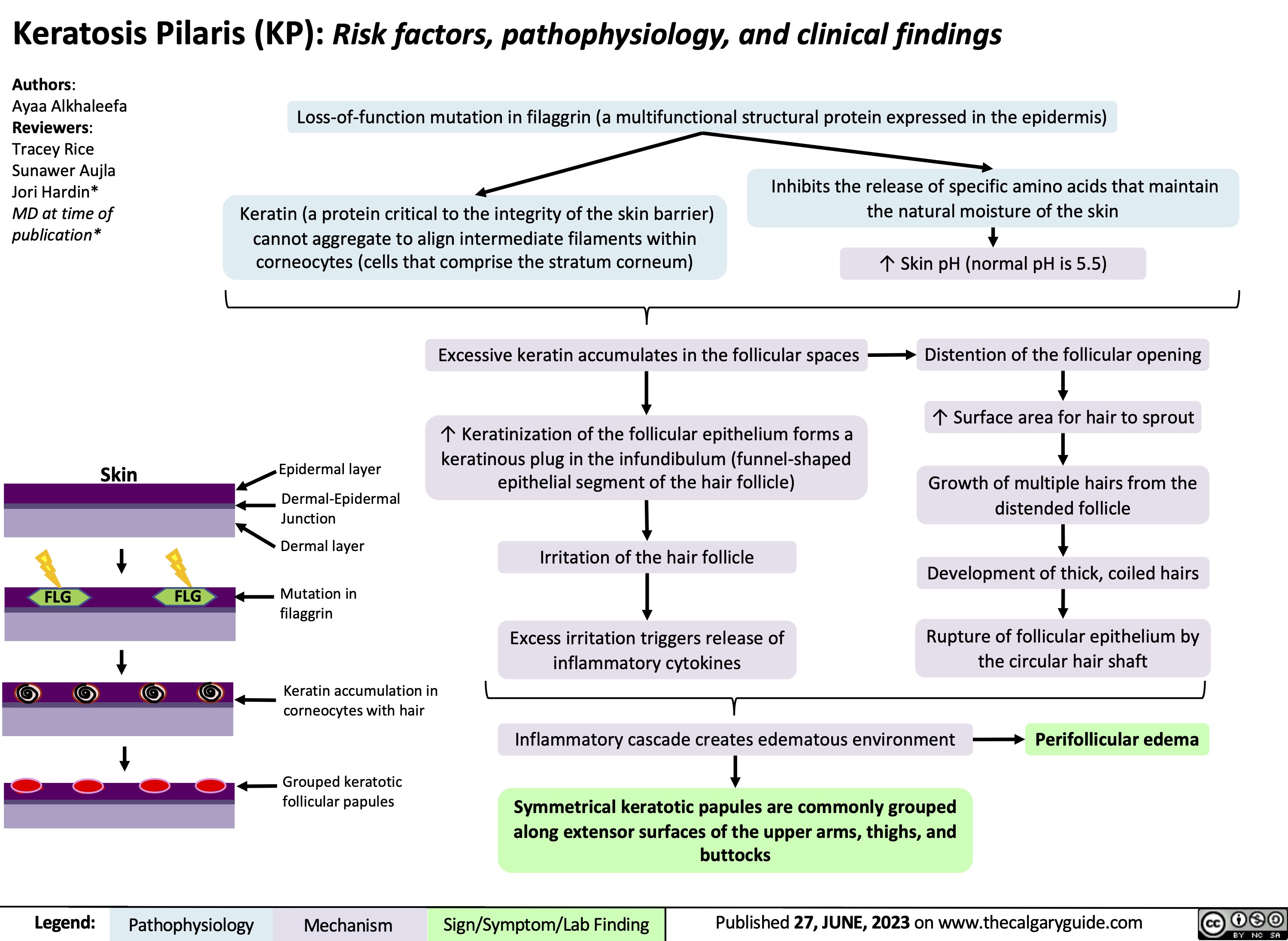 Keratosis Pilaris (KP): Risk factors, pathophysiology, and clinical findings
Authors:
Ayaa Alkhaleefa Reviewers: Tracey Rice Sunawer Aujla Jori Hardin* MD at time of publication*
Loss-of-function mutation in filaggrin (a multifunctional structural protein expressed in the epidermis)
Inhibits the release of specific amino acids that maintain
    Keratin (a protein critical to the integrity of the skin barrier) cannot aggregate to align intermediate filaments within corneocytes (cells that comprise the stratum corneum)
the natural moisture of the skin ↑ Skin pH (normal pH is 5.5)
Distention of the follicular opening
↑ Surface area for hair to sprout
Growth of multiple hairs from the distended follicle
Development of thick, coiled hairs
Rupture of follicular epithelium by the circular hair shaft
    Skin
Epidermal layer
Dermal-Epidermal Junction
Dermal layer
Mutation in filaggrin
Keratin accumulation in corneocytes with hair
Grouped keratotic follicular papules
Excessive keratin accumulates in the follicular spaces
↑ Keratinization of the follicular epithelium forms a keratinous plug in the infundibulum (funnel-shaped epithelial segment of the hair follicle)
Irritation of the hair follicle
Excess irritation triggers release of inflammatory cytokines
         FLG FLG
           Inflammatory cascade creates edematous environment
Symmetrical keratotic papules are commonly grouped along extensor surfaces of the upper arms, thighs, and buttocks
Perifollicular edema
     Legend:
 Pathophysiology
Mechanism
 Sign/Symptom/Lab Finding
 Published 27, JUNE, 2023 on www.thecalgaryguide.com
  