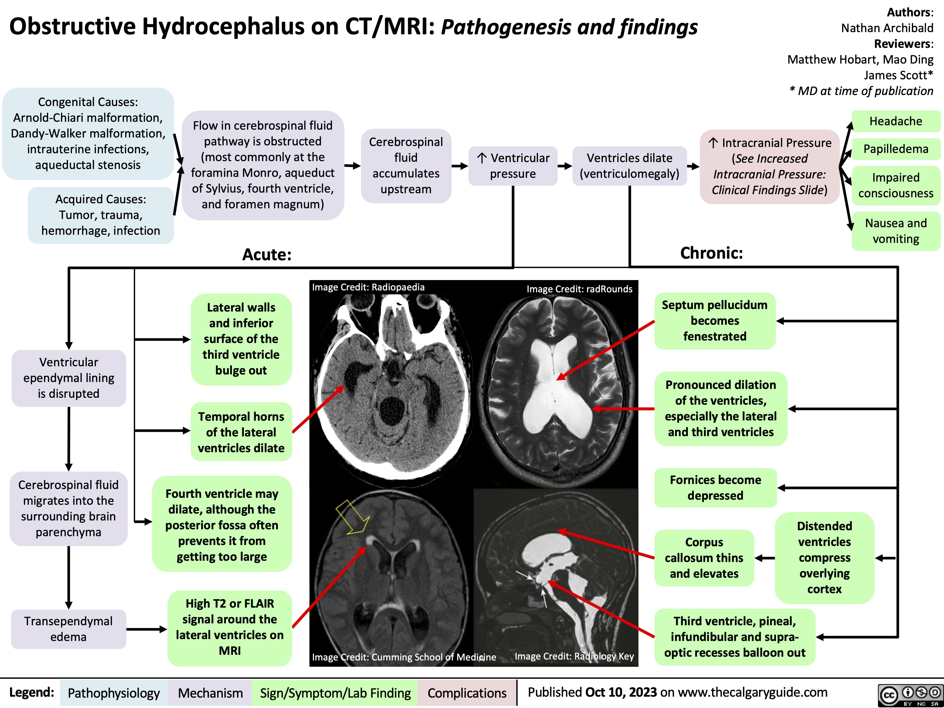 Obstructive Hydrocephalus on CT/MRI: Pathogenesis and findings
Authors: Nathan Archibald Reviewers: Matthew Hobart, Mao Ding James Scott* * MD at time of publication
 Congenital Causes: Arnold-Chiari malformation, Dandy-Walker malformation, intrauterine infections, aqueductal stenosis
Acquired Causes: Tumor, trauma, hemorrhage, infection
Flow in cerebrospinal fluid pathway is obstructed (most commonly at the foramina Monro, aqueduct of Sylvius, fourth ventricle, and foramen magnum)
Acute:
Lateral walls and inferior surface of the third ventricle bulge out
Temporal horns Temporal horns
of the lateral of the lateral
ventricles dilate ventricles dilate
Cerebrospinal fluid accumulates upstream
↑ Ventricular pressure
Ventricles dilate (ventriculomegaly)
↑ Intracranial Pressure (See Increased Intracranial Pressure: Clinical Findings Slide)
Headache Papilledema
Impaired consciousness
Nausea and vomiting
               Image Credit: Radiopaedia
Image Credit: radRounds
        Ventricular ependymal lining is disrupted
Cerebrospinal fluid migrates into the surrounding brain parenchyma
Transependymal edema
Fourth ventricle may Fourth ventricle may
Chronic:
Septum pellucidum becomes fenestrated
Pronounced dilation of the ventricles, especially the lateral and third ventricles
Fornices become depressed
Corpus callosum thins and elevates
               dilate, although the dilate, although the
 posterior fossa often posterior fossa often
Distended ventricles compress overlying cortex
 prevents it from prevents it from
 getting too large getting too large
     High T2 or FLAIR High T2 or FLAIR
signal around the signal around the
lateral ventricles on lateral ventricles on
MRI MRI
Image Credit: Cumming School of Medicine
Image Credit: Radiology Key
Third ventricle, pineal, infundibular and supra- optic recesses balloon out
   Legend:
 Pathophysiology
Mechanism
Sign/Symptom/Lab Finding
 Complications
Published Oct 10, 2023 on www.thecalgaryguide.com
    