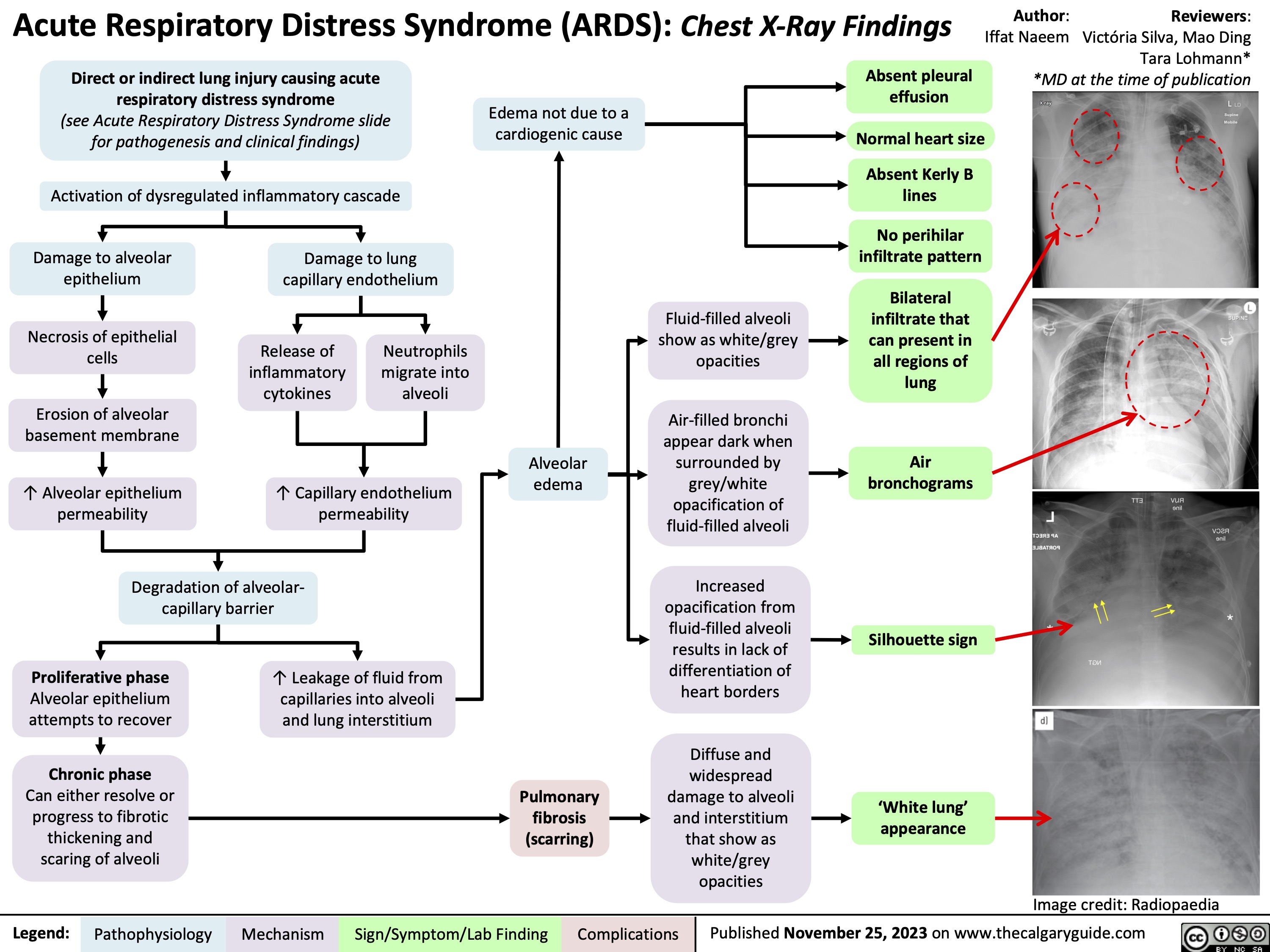 Acute Respiratory Distress Syndrome (ARDS): Chest X-Ray Findings
Author: Iffat Naeem
  Direct or indirect lung injury causing acute respiratory distress syndrome
(see Acute Respiratory Distress Syndrome slide for pathogenesis and clinical findings)
Activation of dysregulated inflammatory cascade
Absent pleural effusion
Normal heart size
Absent Kerly B lines
No perihilar infiltrate pattern
Bilateral infiltrate that can present in all regions of lung
Air bronchograms
Silhouette sign
Reviewers: Victória Silva, Mao Ding Tara Lohmann* *MD at the time of publication
   Edema not due to a cardiogenic cause
            Damage to alveolar epithelium
Necrosis of epithelial cells
Erosion of alveolar basement membrane
↑ Alveolar epithelium permeability
Damage to lung capillary endothelium
          Release of inflammatory cytokines
Neutrophils migrate into alveoli
Fluid-filled alveoli show as white/grey opacities
Air-filled bronchi appear dark when surrounded by grey/white opacification of fluid-filled alveoli
Increased opacification from fluid-filled alveoli results in lack of differentiation of heart borders
Diffuse and
widespread damage to alveoli and interstitium that show as white/grey opacities
        ↑ Capillary endothelium permeability
Alveolar edema
     Degradation of alveolar- capillary barrier
     Proliferative phase
Alveolar epithelium attempts to recover
Chronic phase
Can either resolve or progress to fibrotic thickening and scaring of alveoli
↑ Leakage of fluid from capillaries into alveoli and lung interstitium
    Pulmonary fibrosis (scarring)
‘White lung’ appearance
  Image credit: Radiopaedia
 Legend:
 Pathophysiology
 Mechanism
Sign/Symptom/Lab Finding
 Complications
Published November 25, 2023 on www.thecalgaryguide.com
   
Acute Respiratory Distress Syndrome (ARDS): Chest X-Ray Findings Direct or indirect lung injury causing acute
Author: Iffat Naeem Reviewers: Victória Silva
 respiratory distress syndrome*
Activation of dysregulated inflammatory cascade
Bilateral infiltrate that show as white/grey   can present in
            Damage to alveolar epithelium
Necrosis of epithelial cells
Erosion of alveolar basement membrane
↑ Alveolar epithelium permeability
Damage to lung capillary endothelium
Fluid-filled alveoli opacities
Air-filled bronchi appear dark when surrounded by grey/white opacification of fluid-filled alveoli
Increased opacification from fluid-filled alveoli results in lack of differentiation of heart borders
Diffuse and
all regions of lung
      Release of inflammatory cytokines
Neutrophils migrate into alveoli
Alveolar edema
Air bronchograms
              ↑ Capillary endothelium permeability
    Degradation of alveolar-capillary barrier
       Proliferative phase
Alveolar epithelium attempts to recover
Chronic phase
Can either resolve or progress to fibrotic thickening and scaring of alveoli
↑ Leakage of fluid from capillaries into alveoli and lung interstitium
Silhouette Sign
     widespread Pulmonary   damage to alveoli
‘White lung’ appearance
    fibrosis (scarring)
and interstitium that show as white/grey opacities
 *See corresponding Calgary Guide slides for more details
Image credit: Radiopaedia
 Legend:
 Pathophysiology
 Mechanism
Sign/Symptom/Lab Finding
 Complications
Published X, 2023 on www.thecalgaryguide.com
   
Acute Respiratory Distress Syndrome (ARDS): Chest X-Ray Findings Direct or indirect lung injury causing acute respiratory
Author: Iffat Naeem Reviewers: Victória Silva
 distress syndrome*
Activation of dysregulated inflammatory cascade
Bilateral infiltrate that show as white/grey   can present in
              Damage to alveolar epithelium
Necrosis of epithelial cells
Denudation of alveolar basement membrane
↑ epithelium permeability
Degradation of alveolar-capillary barrier
Alveolar epithelium
attempts to recover through (proliferative phase)
Damage to lung capillary endothelium
Fluid-filled alveoli opacities
Air-filled bronchi appear dark when surrounded by grey/white opacification of fluid-filled alveoli
Increased opacification from fluid-filled alveoli results in lack of differentiation of heart borders
Diffuse and
all regions of lung
Air bronchograms
            Release of proinflamm atory cytokines
Neutrophil migration into airspace
Alveolar Edema
              ↑ capillary endothelium permeability
↑ leakage of fluid from vasculature into airspace and lung interstitium
Can either resolve or progress to fibrotic
Silhouette Sign
           widespread Pulmonary   damage to alveoli
‘White lung’ appearance
      thickening and scaring of   Fibrosis alveoli (chronic phase)
and interstitium that show as white/grey opacities
 Image credit: Radiopaedia
*See corresponding Calgary Guide slides for more details
 Legend:
 Pathophysiology
 Mechanism
Sign/Symptom/Lab Finding
 Complications
Published X, 2023 on www.thecalgaryguide.com
   
 Acute Respiratory Distress Syndrome (ARDS): Chest X-Ray Findings
Absent pleural effusion
Normal heart size
Absent Kerly B lines
No perihilar infiltrate pattern
Author: Iffat Naeem Reviewers: Victória Silva
   Acute Lung Injury (see ‘ARDS: Pathogenesis and Clinical findings’ slide) causing impaired oxygenation
Lung injury not due to cardiogenic cause
         (see ‘ARDS: Pathogenesis and Clinical findings’ slide)
Alveolar endothelium damage promotes inflammatory marker release
Exudative phase (1-6 days): neutrophils adhere to damaged endothelium and release pro- inflammatory mediators
Accumulation of intra-alveolar fluid that is rich in neutrophils, macrophages, and red blood cells
Proliferative phase (7-14 days): proliferation of alveolar epithelial
Fibroblasts deposit collagen tissue in alveolar walls and spaces
Can either resolve or progress to fibrotic thickening and scaring
Alveolar Edema
Fluid-filled alveoli show as white/grey opacities
Air-filled bronchi appear dark when surrounded by grey/white opacification of fluid-filled alveoli
Increased opacification from fluid-filled alveoli
Bilateral infiltrate present in all regions
Air bronchograms
                            results in lack of         Silhouette Sign differentiation of
  heart borders
  Diffuse alveolar damage
‘White lung’ appearance
Image credit: Radiopaedia
    *See corresponding Calgary Guide slides for more details
 Legend:
(chronic phase) Pathophysiology
  Mechanism
Sign/Symptom/Lab Finding
 Complications
Published X, 2023 on www.thecalgaryguide.com
    
    Lung injury not due to a cardiogenic cause
Absent pleural effusion
Normal heart size
Absent Kerly B lines
No perihilar infiltrate pattern
       Acute Respiratory Distress Syndrome (ARDS): Chest X-Ray Findings
  